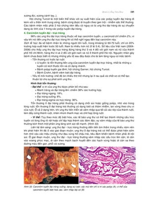 Beänh Lyù OÁng Tieâu Hoùa 185
xöông ñuøi, xöông caùnh tay…).
Hoäi chöùng Turcot laø moät bieán theå khaùc vôùi söï xuaát hieän cuûa caùc polyùp tuyeán ñaïi traøng ñi
keøm vôùi u thaàn kinh trung öông; beänh cuõng ñöôïc di truyeàn theo gen troäi - nhieãm saéc theå thöôøng.
Caùc beänh nhaân maéc phaûi 2 hoäi chöùng treân ñeàu coù nguy cô bò ung thö ñaïi traøng do söï chuyeån
daïng aùc tính cuûa 1 trong caùc polyùp tuyeán ñaïi traøng.
4. Carcinoâm tuyeán ñaïi - tröïc traøng
98% caùc ung thö ñaïi tröïc traøng thuoäc veà loaïi carcinoâm tuyeán, u carcinoid chæ chieám 2%; vì
vaäy khi noùi ñeán ung thö ñaïi tröïc traøng thì coù theå nghó ngay ñeán loaïi carcinoâm naøy.
Dòch teã hoïc: ña soá beänh nhaân laø nhöõng ngöôøi lôùn tuoåi, trong khoaûng töø 60-70 tuoåi; chæ coù 20%
tröôøng hôïp xuaát hieän tröôùc 50 tuoåi. Nam bò nhieàu hôn nöõ (tæ leä 5:4). Soá lieäu cuûa Vieät nam (2004-
2008) cho thaáy ung thö ñaïi tröïc traøng ñöùng haøng thöù 3 vaø 4 ñoái vôùi giôùi nam vaø nöõ cuûa thaønh
phoá Hoà chí Minh; haøng thöù 4 vaø 2 ñoái vôùi giôùi nam vaø nöõ ôû thaønh phoá Haø noäi. Nguyeân nhaân gaây
beänh chöa ñöôïc bieát roõ nhöng nhöõng yeáu toá sau ñaây ñöôïc cho laø laøm taêng nguy cô maéc beänh:
- Toån thöông coù tröôùc taïi ruoät:
+ U tuyeán: laø toån thöông tieàn ung cuûa carcinoâm tuyeán ñaïi-tröïc traøng, nhaát laø nhöõng u
tuyeán coù kích thöôùc lôùn vaø coù daïng nhaùnh.
+ Beänh polyp tuyeán gia ñình, hoäi chöùng Garner, hoäi chöùng Turcot.
+ Beänh Crohn, beänh vieâm loeùt ñaïi traøng.
- Yeáu toá moâi tröôøng: cheá ñoä aên nhieàu thòt môõ nhöng laïi ít rau quaû vaø chaát xô coù theå taïo
thuaän lôïi cho söï phaùt sinh ung thö.
Hình thaùi toån thöông:
- Ñaïi theå: vò trí cuûa ung thö ñöïôïc phaân boá nhö sau:
+ Manh traøng vaø ñaïi traøng leân: chieám 38% caùc tröôøng hôïp.
+ Ñaïi traøng ngang: 18%.
+ Ñaïi traøng xuoáng: 8%.
+ Ñaïi traøng sigma vaø tröïc traøng: 36%.
Toån thöông ôû ñaïi traøng phaûi thöôøng coù daïng choài suøi hoaëc gioáng polyùp, nhoâ vaøo trong
loøng ruoät; toån thöông ôû ñaïi traøng traùi thöôøng coù daïng loeùt vaø thaâm nhieãm, lan voøng theo chu vi
cuûa ruoät. ÔÛ caû 2 daïng treân, khi ung thö tieán trieån seõ xaâm nhaäp qua taát caû caùc lôùp cuûa thaønh ruoät,
laøm daày cöùng thaønh ruoät, nhaên nhuùm thanh maïc vaø chít heïp loøng ruoät.
- Vi theå: Tuøy theo möùc ñoä bieät hoùa, caùc teá baøo ung thö coù theå taïo thaønh nhöõng caáu truùc
tuyeán coù loøng oáng roõ reät hoaëc chæ taäp hôïp thaønh caùc ñaùm ñaëc; söï xaâm nhaäp cuûa teá baøo ung thö
thöôøng kích thích moät phaûn öùng taêng sinh sôïi raát maïnh. (Hình 33)
Lieân heä laâm saøng: ung thö ñaïi - tröïc traøng thöôøng dieãn tieán aâm thaàm trong nhieàu naêm neân
khi phaùt hieän thì ñaõ ôû vaøo giai ñoaïn muoän; ung thö ôû ñaïi traøng traùi coù theå ñöôïc phaùt hieän sôùm
hôn nhôø vaøo caùc trieäu chöùng nhö ñau vuøng hoá chaäu traùi, tieâu ñaøm khieán beänh nhaân phaûi ñi noäi
soi. ÔÛ giai ñoaïn muoän, ung thö ñaïi - tröïc traøng thöôøng xaâm nhaäp caùc caáu truùc laân caän, di caên
vaøo xoang phuùc maïc, di caên theo maïch baïch huyeát ñeán caùc haïch vuøng hoaëc di caên xa theo
ñöôøng maùu ñeán gan, phoåi vaø xöông.
Hình 33: Carcinoâm tuyeán ñaïi traøng xuoáng, daïng suøi loeùt; caùc muõi teân chæ vò trí caùc polyùp (A); vi theå cuûa
carcimoâm tuyeán bieät hoaù cao, xaâm nhaäp lôùp cô (B)
 