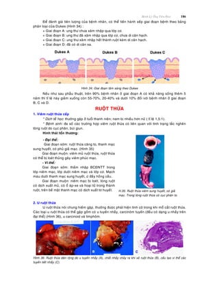 Beänh Lyù OÁng Tieâu Hoùa 186
Ñeå ñaùnh giaù tieân löôïng cuûa beänh nhaân, coù theå tieán haønh xeáp giai ñoaïn beänh theo baûng
phaân loaïi cuûa Dukes (Hình 34) :
+ Giai ñoaïn A: ung thö chöa xaâm nhaäp qua lôùp cô.
+ Giai ñoaïn B: ung thö ñaõ xaâm nhaäp qua lôùp cô, chöa di caên haïch.
+ Giai ñoaïn C: ung thö xaâm nhaäp heát thaønh ruoät keøm di caên haïch.
+ Giai ñoaïn D: ñaõ coù di caên xa.
Hình 34: Giai ñoaïn laâm saøng theo Dukes
Neáu nhö sau phaãu thuaät, treân 90% beänh nhaân ôû giai ñoaïn A coù khaû naêng soáng theâm 5
naêm thì tæ leä naøy giaûm xuoáng coøn 55-70%, 20-40% vaø döôùi 10% ñoái vôùi beänh nhaân ôû giai ñoaïn
B, C vaø D.
RUOÄT THÖØA
1. Vieâm ruoät thöøa caáp
* Dòch teã hoïc: thöôøng gaëp ôû tuoåi thanh nieân; nam bò nhieàu hôn nöõ ( tæ leä 1,5:1).
* Beänh sinh: ña soá caùc tröôøng hôïp vieâm ruoät thöøa coù lieân quan vôùi tình traïng taéc ngheõn
loøng ruoät do cuïc phaân, buùi giun.
Hình thaùi toån thöông:
- Ñaïi theå:
Giai ñoaïn sôùm: ruoät thöøa caêng to, thanh maïc
sung huyeát, coù phuû giaû maïc. (Hình 35)
Giai ñoaïn muoän: vieâm muû ruoät thöøa, ruoät thöøa
coù theå bò loeùt thuûng gaây vieâm phuùc maïc.
- Vi theå:
Giai ñoaïn sôùm: thaám nhaäp BCÑNTT trong
lôùp nieâm maïc, lôùp döôùi nieâm maïc vaø lôùp cô. Maïch
maùu döôùi thanh maïc sung huyeát, öù ñaày hoàng caàu.
Giai ñoaïn muoän: nieâm maïc bò loeùt, loøng ruoät
coù dòch xuaát muû, coù oå aùp-xe vaø hoaïi töû trong thaønh
ruoät, treân beà maët thanh maïc coù dòch xuaát tô huyeát. H.35: Ruoät thöøa vieâm sung huyeát, coù giaû
maïc. Trong loøng ruoät thöøa coù cuïc phaân to.
2. U ruoät thöøa
U ruoät thöøa noùi chung hieám gaëp, thöôøng ñöôïc phaùt hieän tình côø trong khi moå caét ruoät thöøa.
Caùc loaïi u ruoät thöøa coù theå gaëp goàm coù u tuyeán nhaày, carcinoâm tuyeán (ñeàu coù daïng u nhaày treân
ñaïi theå) (Hình 36), u carcinoid vaø limphoâm.
Hình 36: Ruoät thöøa daõn roäng do u tuyeán nhaày (A), chaát nhaày chaûy ra khi xeû ruoät thöøa (B), caáu taïo vi theå caùc
tuyeán tieát nhaày (C).
 