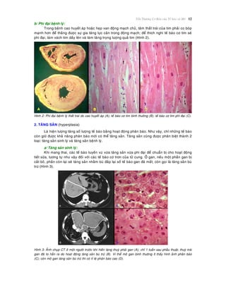 Toån Thöông Cô Baûn cuûa Teá baøo vaø Moâ 12
b/ Phì ñaïi beänh lyù:
Trong beänh cao huyeát aùp hoaëc heïp van ñoäng maïch chuû, taâm thaát traùi cuûa tim phaûi co boùp
maïnh hôn ñeå thaéng ñöôïc söï gia taêng löïc caûn trong ñoäng maïch; ñeå thích nghi teá baøo cô tim seõ
phì ñaïi, laøm vaùch tim daày leân vaø laøm taêng troïng löôïng quaû tim (Hình 2).
Hình 2: Phì ñaïi beänh lyù thaát traùi do cao huyeát aùp (A); teá baøo cô tim bình thöôøng (B); teá baøo cô tim phì ñaïi (C).
2. TAÊNG SAÛN (hyperplasia)
Laø hieän töôïng taêng soá löôïng teá baøo baèng hoaït ñoäng phaân baøo. Nhö vaäy, chæ nhöõng teá baøo
coøn giöõ ñöôïc khaû naêng phaân baøo môùi coù theå taêng saûn. Taêng saûn cuõng ñöôïc phaân bieät thaønh 2
loaïi: taêng saûn sinh lyù vaø taêng saûn beänh lyù.
a/ Taêng saûn sinh lyù:
Khi mang thai, caùc teá baøo tuyeán vuù vöøa taêng saûn vöøa phì ñaïi ñeå chuaån bò cho hoaït ñoäng
tieát söõa, töông töï nhö vaäy ñoái vôùi caùc teá baøo cô trôn cuûa töû cung. ÔÛ gan, neáu moät phaàn gan bò
caét boû, phaàn coøn laïi seõ taêng saûn nhaèm buø ñaép laïi soá teá baøo gan ñaõ maát, coøn goïi laø taêng saûn buø
tröø (Hình 3).
Hình 3: AÛnh chuïp CT ôû moät ngöôøi tröôùc khi hieán taëng thuyø phaûi gan (A); chæ 1 tuaàn sau phaãu thuaät, thuyø traùi
gan ñaõ to haún ra do hoaït ñoäng taêng saûn buø tröø (B). Vi theå moâ gan bình thöôøng ít thaáy hình aûnh phaân baøo
(C); coøn moâ gan taêng saûn buø tröø thì coù tæ leä phaân baøo cao (D).
 