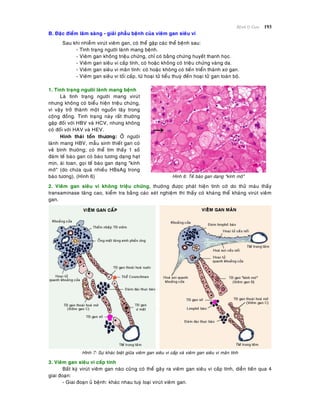 Beänh lyù Gan 193
B. Ñaëc ñieåm laâm saøng - giaûi phaãu beänh cuûa vieâm gan sieâu vi
Sau khi nhieãm viruùt vieâm gan, coù theå gaëp caùc theå beänh sau:
- Tình traïng ngöôøi laønh mang beänh.
- Vieâm gan khoâng trieäu chöùng, chæ coù baèng chöùng huyeát thanh hoïc.
- Vieâm gan sieâu vi caáp tính, coù hoaëc khoâng coù trieäu chöùng vaøng da.
- Vieâm gan sieâu vi maõn tính: coù hoaëc khoâng coù tieán trieån thaønh xô gan.
- Vieâm gan sieâu vi toái caáp, töø hoaïi töû tieåu thuyø ñeán hoaïi töû gan toaøn boä.
1. Tình traïng ngöôøi laønh mang beänh
Laø tình traïng ngöôøi mang viruùt
nhöng khoâng coù bieåu hieän trieäu chöùng,
vì vaäy trôû thaønh moät nguoàn laây trong
coäng ñoàng. Tình traïng naøy raát thöôøng
gaëp ñoái vôùi HBV vaø HCV, nhöng khoâng
coù ñoái vôùi HAV vaø HEV.
Hình thaùi toån thöông: ÔÛ ngöôøi
laønh mang HBV, maãu sinh thieát gan coù
veû bình thöôøng; coù theå tìm thaáy 1 soá
ñaùm teá baøo gan coù baøo töông daïng haït
mòn, aùi toan, goïi teá baøo gan daïng "kính
môø" (do chöùa quaù nhieàu HBsAg trong
baøo töông). (Hình 6) Hình 6: Teá baøo gan daïng "kính môø"
2. Vieâm gan sieâu vi khoâng trieäu chöùng, thöôøng ñöôïc phaùt hieän tình côø do thöû maùu thaáy
transaminase taêng cao, kieåm tra baèng caùc xeùt nghieäm thì thaáy coù khaùng theå khaùng viruùt vieâm
gan.
Hình 7: Söï khaùc bieät giöõa vieâm gan sieâu vi caáp vaø vieâm gan sieâu vi maõn tính
3. Vieâm gan sieâu vi caáp tính
Baát kyø viruùt vieâm gan naøo cuõng coù theå gaây ra vieâm gan sieâu vi caáp tính, dieãn tieán qua 4
giai ñoaïn:
- Giai ñoaïn uû beänh: khaùc nhau tuyø loaïi viruùt vieâm gan.
 