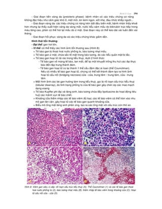 Beänh lyù Gan 194
- Giai ñoaïn tieàn vaøng da (preicteric phase): beänh nhaân coù caùc trieäu chöùng cô naêng
khoâng ñaëc hieäu nhö caûm giaùc khoù ôû, meät moûi, aên keùm ngon, soát nheï, ñau nhöùc khaéùp ngöôøi...
- Giai ñoaïn vaøng da: caùc trieäu chöùng cô naêng treân baét ñaàu bieán maát, beänh nhaân thaáy khoeû
hôn nhöng laïi thaáy xuaát hieän vaøng da vaøng maét, nöôùc tieåu xaäm maàu do bibirubin tröïc tieáp trong
maùu taêng cao, phaân coù theå hôi laït maàu do öù maät. Giai ñoaïn naøy coù theå keùo daøi vaøi tuaàn ñeán vaøi
thaùng.
- Giai ñoaïn hoài phuïc: vaøng da vaø caùc trieäu chöùng khaùc giaûm daàn.
Hình thaùi toån thöông:
- Ñaïi theå: gan hôi lôùn.
- Vi theå: coù theå thaáy caùc hình aûnh toån thöông sau (Hình 8):
+ Teá baøo gan bò thoaùi hoaù nöôùc phoàng to, baøo töông nhaït maàu.
+ Teá baøo gan öù maät, chöùa saéc toá maät trong baøo töông, do caùc tieåu quaûn maät bò taéc.
+ Teá baøo gan hoaïi töû raûi raùc trong tieåu thuyø, döôùi 2 hình thöùc:
- Teá baøo gan vôõ maøng teá baøo, tan maát, ñeå laïi moät khuyeát troáng thu huùt caùc ñaïi thöïc
baøo ñeán taäp trung thaønh ñaùm.
- Teá baøo gan hoaïi töû co laïi thaønh 1 theå caàu ñaäm ñaëc aùi toan (theå Councilman).
Neáu coù nhieàu teá baøo gan hoaïi töû, chuùng coù theå keát thaønh ñaùm taïo ra hình aûnh
hoaïi töû caàu noái (bridging necrosis) cöûa - cöûa, trung taâm - trung taâm, cöûa - trung
taâm.
+ Maát hình aûnh caùc beø gan höôùng taâm trong tieåu thuyø, goïi laø roái loaïn caáu truùc tieåu thuyø
(lobular disarray), do tình traïng phoàng to cuûa teá baøo gan gaây cheøn eùp caùc mao maïch
daïng xoang.
+ Teá baøo Kupffer phì ñaïi vaø taêng sinh, baøo töông chöùa ñaày lipofuscine do hoaït ñoäng tieâu
huyû caùc maûnh vuïn teá baøo cheát.
+ Khoaûng cöûa thaám nhaäp caùc teá baøo vieâm ñuû loaïi; caùc teá baøo vieâm coù theå traøn vaøo nhu
moâ gan laân caän, gaây hoaïi töû caùc teá baøo gan quanh khoaûng cöûa.
+ Bieåu moâ oáng maät taêng sinh phaûn öùng, taïo ra caùc oáng maät vôùi caáu truùc coøn thoâ sô.
Hình 8: Vieâm gan sieâu vi caáp: roái loaïn caáu truùc tieåu thuyø (A); Theå Councilman (1) vaø caùc teá baøo gan thoaùi
hoaù nöôùc phoàng to (2), baøo töông nhaït maàu (B); thaám nhaäp teá baøo vieâm trong khoaûng cöûa (C); Hoaïi
töû caàu noái cöûa - cöûa (D)
 