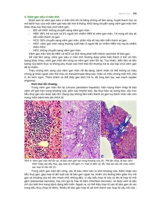 Beänh lyù Gan 195
4. Vieâm gan sieâu vi maõn tính
Ñöôïc xem laø vieâm gan sieâu vi maõn tính khi coù baèng chöùng veà laâm saøng, huyeát thanh hoïc vaø
moâ beänh hoïc cuûa moät vieâm gan keùo daøi hôn 6 thaùng. Khaû naêng chuyeån sang vieâm gan maõn tính
khaùc nhau tuyø theo loaïi viruùt vieâm gan:
- Ñoái vôùi HAV: khoâng chuyeån sang vieâm gan maõn.
- HBV: 90% treû sô sinh vaø 5% ngöôøi lôùn nhieãm HBV bò vieâm gan maõn, 1/4 trong soá naøy seõ
tieán trieån thaønh xô gan.
- HCV: 50% chuyeån sang vieâm gan maõn, phaân nöûa soá naøy tieán trieån thaønh xô gan.
- HDV: vieâm gan maõn naëng thöôøng xuaát hieän ôû ngöôøi ñaõ coù nhieãm HBV maø nay bò nhieãm
theâm HDV.
- HEV: khoâng chuyeån sang vieâm gan maõn.
Vieâm gan maõn tính do HBV vaø HCV coù khaû naêng phaùt trieån thaønh carcinoâm teá baøo gan.
Veà maët laâm saøng, vieâm gan sieâu vi maõn tính thöôøng ñöôïc phaân bieät thaønh 2 theå vôùi tieân
löôïng khaùc nhau, vieâm gan maõn taán coâng vaø vieâm gan maõn toàn taïi. Tuy nhieân, dieãn tieán vaø tieân
löôïng cuûa beänh thöïc ra khoâng phuï thuoäc vaøo hình thaùi toån thöông maø laø vaøo loaïi viruùt vieâm gan
ñaõ bò nhieãm.
Trieäu chöùng laâm saøng cuûa vieâm gan maõn raát ña daïng, beänh nhaân coù theå khoâng coù trieäu
chöùng gì khaùc ngoaøi vieäc thöû maùu coù transaminase taêng cao; hoaëc coù trieäu chöùng meät moûi, khoù
ôû, aên keùm ngon. Thaêm khaùm coù theå thaáy gan laùch hôi to, ñoû loøng baøn tay, sao maïch (spider
angioma).
Hình thaùi toån thöông:
Trong vieâm gan maõn toàn taïi (chronic persistent hepatitis), hieän töôïng thaám nhaäp teá baøo
vieâm chæ giôùi haïn trong khoaûng cöûa, goàm caùc limphoâ baøo, ñaïi thöïc baøo vaø töông baøo; caáu truùc
tieåu thuyø gan coøn ñöôïc baûo toàn. Daïng naøy khoâng tieán trieån thaønh xô gan tuy beänh nhaân vaãn coøn
mang maàm beänh keùo daøi (Hình 9).
Hình 9: Vieâm gan maõn theå toàn taïi, teá baøo vieâm giôùi haïn trong khoaûng cöûa (A); Theå taán coâng, teá baøo vieâm
thaám nhaäp vaøo tieåu thuyø, gaây hoaïi töû moái gaëm (1), hoaïi töû ñoám (2) (B); Hoaù sôiï caàu noái (maøu xanh)
sau hoaïi töû caàu noái (C).
Trong vieâm gan maõn taán coâng, caùc teá baøo vieâm traøn ra khoûi khoaûng cöûa, thaám nhaäp vaøo
tieåu thuyø gan, gaây hoaïi töû laàn löôït caùc teá baøo gan ngoaøi rìa, khieán cho ñöôøng bieân giöõa nhu moâ
gan vaø khoaûng cuûa trôû neân nham nhôû, khoâng ñeàu; vì vaäy kieåu hoaïi töû naøy coù teân laø hoaïi töû moái
gaëm (piecemeal necrosis), hay coøn goïi laø hoaïi töû bieân (interface necrosis), vaø ñöôïc xem laø daáu
chæ cho bieát tình traïng beänh ñang tieán trieån. Ngoaøi ra, coù theå thaáy hoaïi töû caùc teá baøo gan raûi raùc
trong tieåu thuøy (hoaïi töû ñoám). Nhieàu teá baøo gan hoaïi töû seõ hình thaønh caùc hoaïi töû caàu noái cöûa -
 