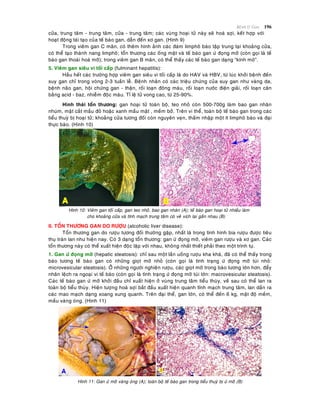Beänh lyù Gan 196
cöûa, trung taâm - trung taâm, cöûa - trung taâm; caùc vuøng hoaïi töû naøy seõ hoaù sôïi, keát hôïp vôùi
hoaït ñoäng taùi taïo cuûa teá baøo gan, daãn ñeán xô gan. (Hình 9)
Trong vieâm gan C maõn, coù theâm hình aûnh caùc ñaùm limphoâ baøo taäp trung taïi khoaûng cöûa,
coù theå taïo thaønh nang limphoâ; toån thöông caùc oáng maät vaø teá baøo gan öù ñoïng môõ (coøn goïi laø teá
baøo gan thoaùi hoaù môõ); trong vieâm gan B maõn, coù theå thaáy caùc teá baøo gan daïng “kính môø”.
5. Vieâm gan sieâu vi toái caáp (fulminant hepatitis):
Haàu heát caùc tröôøng hôïp vieâm gan sieâu vi toái caáp laø do HAV vaø HBV, töø luùc khôûi beänh ñeán
suy gan chæ trong voøng 2-3 tuaàn leã. Beänh nhaân coù caùc trieäu chöùng cuûa suy gan nhö vaøng da,
beänh naõo gan, hoäi chöùng gan - thaän, roái loaïn ñoâng maùu, roái loaïn nöôùc ñieän giaûi, roái loaïn caân
baèng acid - baz, nhieãm ñoäc maùu. Tæ leä töû vong cao, töø 25-90%.
Hình thaùi toån thöông: gan hoaïi töû toaøn boä, teo nhoû coøn 500-700g laøm bao gan nhaên
nhuùm, maët caét maàu ñoû hoaëc xanh maàu maät , meàm bôû. Treân vi theå, toaøn boä teá baøo gan trong caùc
tieåu thuyø bò hoaïi töû; khoaûng cöûa töông ñoái coøn nguyeân veïn, thaám nhaäp moät ít limphoâ baøo vaø ñaïi
thöïc baøo. (Hình 10)
Hình 10: Vieâm gan toái caáp, gan teo nhoû, bao gan nhaên (A); teá baøo gan hoaïi töû nhieàu laøm
cho khoaûng cöûa vaø tónh maïch trung taâm coù veû xích laïi gaàn nhau (B)
II. TOÅN THÖÔNG GAN DO RÖÔÏU (alcoholic liver disease):
Toån thöông gan do röôïu töông ñoái thöôøng gaëp, nhaát laø trong tình hình bia röôïu ñöôïc tieâu
thuï traøn lan nhö hieän nay. Coù 3 daïng toån thöông: gan öù ñoïng môõ, vieâm gan röôïu vaø xô gan. Caùc
toån thöông naøy coù theå xuaát hieän ñoäc laäp vôùi nhau, khoâng nhaát thieát phaûi theo moät trình töï.
1. Gan öù ñoïng môõ (hepatic steatosis): chæ sau moät laàn uoáng röôïu kha khaù, ñaõ coù theå thaáy trong
baøo töông teá baøo gan coù nhöõng gioït môõ nhoû (coøn goïi laø tình traïng öù ñoïng môõ tuùi nhoû:
microvesicular steatosis). ÔÛ nhöõng ngöôøi nghieän röôïu, caùc gioït môõ trong baøo töông lôùn hôn, ñaåy
nhaân leäch ra ngoaïi vi teá baøo (coøn goïi laø tình traïng öù ñoïng môõ tuùi lôùn: macrovesicular steatosis).
Caùc teá baøo gan öù môõ khôûi ñaàu chæ xuaát hieän ôû vuøng trung taâm tieåu thuøy, veà sau coù theå lan ra
toaøn boä tieåu thuøy. Hieän töôïng hoaù sôïi baét ñaàu xuaát hieän quanh tónh maïch trung taâm, lan daàn ra
caùc mao maïch daïng xoang xung quanh. Treân ñaïi theå, gan lôùn, coù theå ñeán 6 kg, maät ñoä meàm,
maàu vaøng oùng. (Hình 11)
Hình 11: Gan öù môõ vaøng oùng (A); toaøn boä teá baøo gan trong tieåu thuyø bò öù môõ (B)
 