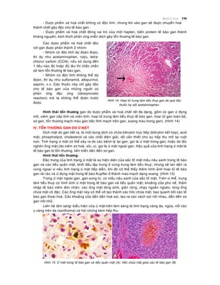 Beänh lyù Gan 198
- Döôïc phaåm vaø hoaù chaát khoâng coù ñoäc tính, nhöng khi vaøo gan seõ ñöôïc chuyeån hoaù
thaønh chaát gaây ñoäc cho teá baøo gan.
- Döôïc phaåm vaø hoaù chaát ñoùng vai troø cuûa moät hapten, bieán protein teá baøo gan thaønh
khaùng nguyeân, kích thích phaûn öùng mieãn dòch gaây toån thöông teá baøo gan.
Caùc döôïc phaåm vaø hoaù chaát ñoäc
vôùi gan ñöôïc phaân thaønh 2 nhoùm:
- Nhoùm coù ñoäc tính döï ñoaùn ñöôïc,
thí duï nhö acetaminophen, röôïu, tetra-
chlorur carbon (CCl4); neáu söû duïng ñeán
1 lieàu naøo ñoù hoaëc ñuû laâu thì chaéc chaén
seõ laøm toån thöông teá baøo gan.
- Nhoùm coù ñoäc tính khoâng theå döï
ñoaùn, thí duï nhö sulfonamid, allopurinol,
aspirin, v.v. Caùc thuoác naøy chæ gaây ñoäc
cho teá baøo gan cuûa nhöõng ngöôøi coù
phaûn öùng ñaëc öùng (idiosyncratic
reaction) maø ta khoâng theå ñoaùn tröôùc
ñöôïc.
Hình 14: Hoaïi töû trung taâm tieåu thuyø gan do quaù lieàu
thuoác haï soát acetaminophen.
Hình thaùi toån thöông gan do döôïc phaåm vaø hoaù chaát raát ña daïng, goàm coù gan öù ñoïng
môõ, vieâm gan caáp tính vaø maõn tính, hoaïi töû trung taâm tieåu thuyø teá baøo gan, hoaïi töû gan toaøn boä,
xô gan, toån thöông maïch maùu gan (taéc tónh maïch treân gan, xoang maùu trong gan). (Hình 14)
IV. TOÅN THÖÔNG GAN DO ÖÙ MAÄT
Dòch maät do gan tieát ra, laø moät dung dòch coù chöùa bilirubin tröïc tieáp (bilirubin keát hôïp), acid
maät, phospholipid, cholesterol vaø caùc chaát ñieän giaûi; raát caàn thieát cho söï haáp thu môõ taïi ruoät
non. Tình traïng öù maät coù theå xaûy ra do caùc beänh lyù taïi gan, goïi laø öù maät trong gan; hoaëc do taéc
ngheõn oáng maät (do vieâm xô hoaù, soûi, u), goïi laø öù maät ngoaøi gan. Haäu quaû cuûa tình traïng öù maät laø
teá baøo gan bò toån thöông, tieán trieån daàn ñeán xô gan.
Hình thaùi toån thöông:
Ñaëc tröng cuûa tình traïng öù maät laø söï hieän dieän cuûa saéc toá maät maàu naâu xanh trong teá baøo
gan vaø caùc tieåu quaûn maät, khôûi ñaàu taäp trung ôû vuøng trung taâm tieåu thuyø; nhöng seõ lan daàn ra
vuøng ngoaïi vi neáu tình traïng öù maät tieáp dieãn, khi ñoù coù theå thaáy theâm hình aûnh hoaïi töû teá baøo
gan raûi raùc vaø öù ñoïng maät trong teá baøo Kupffer ôû thaønh mao maïch daïng xoang. (Hình 15)
Trong öù maät ngoaøi gan, gan söng to, coù maàu naâu xanh cuûa saéc toá maät. Treân vi theå, trung
taâm tieåu thuyø coù hình aûnh öù maät trong teá baøo gan vaø tieåu quaûn maät; khoaûng cöûa phuø neà, thaám
nhaäp teá baøo vieâm ñôn nhaân, caùc oáng maät taêng sinh, giaõn roäng, chaïy ngoaèn ngoeøo, loøng oáng
chöùa maät coâ ñaëc. Caùc oáng maät naøy coù theå vôõ taïo thaønh caùc hoác chöùa maät, bao quanh bôûi caùc teá
baøo gan thoaùi hoaù. Caùc khoaûng cöûa daàn daàn hoaù sôïi, taïo ra caùc vaùch sôïi noái nhau, daãn ñeán xô
gan noát nhoû.
Lieân heä laâm saøng: bieåu hieän cuûa öù maät treân laâm saøng laø tình traïng vaøng da, ngöùa, noåi caùc
u vaøng treân da (xanthoma) vaø hoäi chöùng keùm haáp thu.
Hình 15: ÖÙ maät trong teá baøo gan vaø tieåu quaûn maät (A), Hoác chöùa maät giöõa caùc teá baøo gan (B)
 