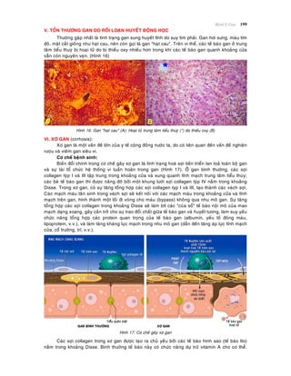 Beänh lyù Gan 199
V. TOÅN THÖÔNG GAN DO ROÁI LOAÏN HUYEÁT ÑOÄNG HOÏC
Thöôøng gaëp nhaát laø tình traïng gan sung huyeát tónh do suy tim phaûi. Gan hôi söng, maøu tím
ñoû, maët caét gioáng nhö haït cau, neân coøn goïi laø gan "haït cau". Treân vi theå, caùc teá baøo gan ôû trung
taâm tieåu thuyø bò hoaïi töû do bò thieáu oxy nhieàu hôn trong khi caùc teá baøo gan quanh khoaûng cöûa
vaãn coøn nguyeân veïn. (Hình 16)
Hình 16: Gan "haït cau" (A); Hoaïi töû trung taâm tieåu thuyø (*) do thieáu oxy (B)
VI. XÔ GAN (cirrhosis):
Xô gan laø moät vaán ñeà lôùn cuûa y teá coäng ñoàng nöôùc ta, do coù lieân quan ñeán vaán ñeà nghieän
röôïu vaø vieâm gan sieâu vi.
Cô cheá beänh sinh:
Bieán ñoåi chính trong cô cheá gaây xô gan laø tình traïng hoaù sôïi tieán trieån lan toaû toaøn boä gan
vaø söï taùi toå chöùc heä thoáng vi tuaàn hoaøn trong gan (Hình 17). ÔÛ gan bình thöôøng, caùc sôïi
collagen tyùp I vaø III taäp trung trong khoaûng cöûa vaø xung quanh tónh maïch trung taâm tieåu thuøy;
caùc beø teá baøo gan thì ñöôïc naâng ñôõ bôûi moät khung löôùi sôïi collagen tyùp IV naèm trong khoaûng
Disse. Trong xô gan, coù söï taêng toång hôïp caùc sôïi collagen typ I vaø III, taïo thaønh caùc vaùch sôïi.
Caùc maïch maùu taân sinh trong vaùch sôïi seõ keát noái vôùi caùc maïch maùu trong khoaûng cöûa vaø tónh
maïch treân gan, hình thaønh moät loái ñi voøng cho maùu (bypass) khoâng qua nhu moâ gan. Söï taêng
toång hôïp caùc sôïi collagen trong khoaûng Disse seõ laøm bít caùc "cuûa soå" teá baøo noäi moâ cuûa mao
maïch daïng xoang, gaây caûn trôû cho söï trao ñoåi chaát giöõa teá baøo gan vaø huyeát töông, laøm suy yeáu
chöùc naêng toång hôïp caùc protein quan troïng cuûa teá baøo gan (albumin, yeáu toá ñoâng maùu,
lipoprotein, v.v.), vaø laøm taêng khaùng löïc maïch trong nhu moâ gan (daãn ñeán taêng aùp löïc tónh maïch
cöûa, coå tröôùng, tró, v.v.).
Hình 17: Cô cheá gaây xô gan
Caùc sôïi collagen trong xô gan ñöôïc taïo ra chuû yeáu bôûi caùc teá baøo hình sao (teá baøo Ito)
naèm trong khoaûng Disse. Bình thöôøng teá baøo naøy coù chöùc naêng döï tröõ vitamin A cho cô theå.
 