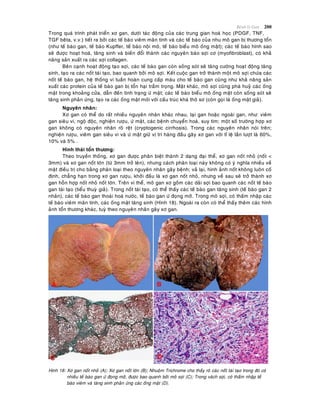 Beänh lyù Gan 200
Trong quaù trình phaùt trieån xô gan, döôùi taùc ñoäng cuûa caùc trung gian hoaù hoïc (PDGF, TNF,
TGF beâta, v.v.) tieát ra bôûi caùc teá baøo vieâm maõn tính vaø caùc teá baøo cuûa nhu moâ gan bò thöông toån
(nhö teá baøo gan, teá baøo Kupffer, teá baøo noäi moâ, teá baøo bieåu moâ oáng maät); caùc teá baøo hình sao
seõ ñöôïc hoaït hoaù, taêng sinh vaø bieán ñoåi thaønh caùc nguyeân baøo sôïi cô (myofibroblast), coù khaû
naêng saûn xuaát ra caùc sôïi collagen.
Beân caïnh hoaït ñoäng taïo sôïi, caùc teá baøo gan coøn soáng soùt seõ taêng cöôøng hoaït ñoäng taêng
sinh, taïo ra caùc noát taùi taïo, bao quanh bôûi moâ sôïi. Keát cuoäc gan trôû thaønh moät moâ sôïi chöùa caùc
noát teá baøo gan, heä thoáng vi tuaàn hoaøn cung caáp maùu cho teá baøo gan cuõng nhö khaû naêng saûn
xuaát caùc protein cuûa teá baøo gan bò toån haïi traàm troïng. Maët khaùc, moâ sôïi cuõng phaù huyû caùc oáng
maät trong khoaûng cöûa, daãn ñeán tình traïng öù maät; caùc teá baøo bieåu moâ oáng maät coøn soáng soùt seõ
taêng sinh phaûn öùng, taïo ra caùc oáng maät môùi vôùi caáu truùc khaù thoâ sô (coøn goïi laø oáng maät giaû).
Nguyeân nhaân:
Xô gan coù theå do raát nhieàu nguyeân nhaân khaùc nhau, taïi gan hoaëc ngoaøi gan, nhö: vieâm
gan sieâu vi, ngoä ñoäc, nghieän röôïu, öù maät, caùc beänh chuyeån hoaù, suy tim; moät soá tröôøng hôïp xô
gan khoâng coù nguyeân nhaân roõ reät (cryptogenic cirrhosis). Trong caùc nguyeân nhaân noùi treân;
nghieän röôïu, vieâm gan sieâu vi vaø öù maät giöõ vò trí haøng ñaàu gaây xô gan vôùi tæ leä laàn löôït laø 60%,
10% vaø 5% .
Hình thaùi toån thöông:
Theo truyeàn thoáng, xô gan ñöôïc phaân bieät thaønh 2 daïng ñaïi theå, xô gan noát nhoû (noát <
3mm) vaø xô gan noát lôùn (töø 3mm trôû leân), nhöng caùch phaân loaïi naøy khoâng coù yù nghóa nhieàu veà
maët ñieàu trò cho baèng phaân loaïi theo nguyeân nhaân gaây beänh; vaû laïi, hình aûnh noát khoâng luoân coá
ñònh, chaúng haïn trong xô gan röôïu, khôûi ñaàu laø xô gan noát nhoû, nhöng veà sau seõ trôû thaønh xô
gan hoãn hôïp noát nhoû noát lôùn. Treân vi theå, moâ gan xô goàm caùc daûi sôïi bao quanh caùc noát teá baøo
gan taùi taïo (tieåu thuyø giaû). Trong noát taùi taïo, coù theå thaáy caùc teá baøo gan taêng sinh (teá baøo gan 2
nhaân), caùc teá baøo gan thoaùi hoaù nöôùc, teá baøo gan öù ñoïng môõ. Trong moâ sôïi, coù thaám nhaäp caùc
teá baøo vieâm maõn tính, caùc oáng maät taêng sinh (Hình 18). Ngoaøi ra coøn coù theå thaáy theâm caùc hình
aûnh toån thöông khaùc, tuyø theo nguyeân nhaân gaây xô gan.
Hình 18: Xô gan noát nhoû (A); Xô gan noát lôùn (B); Nhuoäm Trichrome cho thaáy roõ caùc noát taùi taïo trong ñoù coù
nhieàu teá baøo gan öù ñoïng môõ, ñöôïc bao quanh bôûi moâ sôïi (C); Trong vaùch sôïi, coù thaám nhaäp teá
baøo vieâm vaø taêng sinh phaûn öùng caùc oáng maät (D).
 