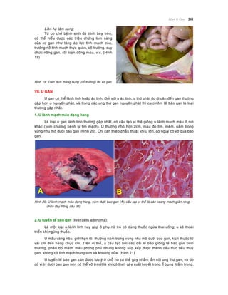 Beänh lyù Gan 201
Lieân heä laâm saøng:
Töø cô cheá beänh sinh ñaõ trình baøy treân,
coù theå hieåu ñöôïc caùc trieäu chöùng laâm saøng
cuûa xô gan nhö taêng aùp löïc tónh maïch cuûa,
tröôùng nôû tónh maïch thöïc quaûn, coå tröôùng, suy
chöùc naêng gan, roái loaïn ñoâng maùu, v.v. (Hình
19)
Hình 19: Traøn dòch maøng buïng (coå tröôùng) do xô gan
VII. U GAN
U gan coù theå laønh tính hoaëc aùc tính. Ñoái vôùi u aùc tính, u thöù phaùt do di caên ñeán gan thöôøng
gaëp hôn u nguyeân phaùt, vaø trong caùc ung thö gan nguyeân phaùt thì carcinoâm teá baøo gan laø loaïi
thöôøng gaëp nhaát.
1. U laønh maïch maùu daïng hang
Laø loaïi u gan laønh tính thöôøng gaëp nhaát, coù caáu taïo vi theå gioáng u laønh maïch maùu ôû nôi
khaùc (xem chöông beänh lyù tim maïch). U thöôøng nhoû hôn 2cm, maàu ñoû tím, meàm, naèm trong
vuøng nhu moâ döôùi bao gan (Hình 20). Chæ can thieäp phaãu thuaät khi u lôùn, coù nguy cô vôõ qua bao
gan.
Hình 20: U laønh maïch maùu daïng hang, naèm döôùi bao gan (A); caáu taïo vi theå laø caùc xoang maïch giaõn roäng,
chöùa ñaày hoàng caàu (B)
2. U tuyeán teá baøo gan (liver cells adenoma):
Laø moät loaïi u laønh tính hay gaëp ôû phuï nöõ treû coù duøng thuoác ngöøa thai uoáng; u seõ thoaùi
trieån khi ngöøng thuoác.
U maàu vaøng naâu, giôùi haïn roõ, thöôøng naèm trong vuøng nhu moâ döôùi bao gan, kích thöôùc töø
vaøi cm ñeán haøng chuïc cm. Treân vi theå, u caáu taïo bôûi caùc daûi teá baøo gioáng teá baøo gan bình
thöôøng, phaân boá maïch maùu phong phuù nhöng khoâng saép xeáp ñöôïc thaønh caáu truùc tieåu thuyø
gan, khoâng coù tónh maïch trung taâm vaø khoaûng cöûa. (Hình 21)
U tuyeán teá baøo gan caàn ñöôïc löu yù ôû choã noù coù theå gaây nhaàm laãn vôùi ung thö gan, vaø do
coù vò trí döôùi bao gan neân coù theå vôõ (nhaát laø khi coù thai) gaây xuaát huyeát trong oå buïng traàm troïng.
 