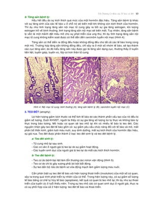 Toån Thöông Cô Baûn cuûa Teá baøo vaø Moâ 13
b/ Taêng saûn beänh lyù:
Haàu heát ñeàu do söï kích thích quaù möùc cuûa moät hormoân ñaëc hieäu. Taêng saûn beänh lyù khaùc
vôùi söï taêng sinh cuûa caùc teá baøo u ôû choã noù seõ bieán maát khi khoâng coøn kích thích cuûa hormoân.
Thí duï nhö tình traïng taêng saûn noäi maïc töû cung gaây ra bôûi söï gia taêng estrogen, khi löôïng
estrogen trôû veà bình thöôøng, tình traïng taêng saûn noäi maïc seõ bieán maát. Tuy nhieân, taêng saûn beänh
lyù vaãn laø moät maûnh ñaát maàu môõ cho söï phaùt trieån cuûa ung thö, thí duï tình traïng taêng saûn noäi
maïc töû cung khoâng kieåm soaùt ñöôïc coù theå daãn ñeán carcinoâm tuyeán noäi maïc (Hình 4).
Taêng saûn coù theå dieãn ra ñoàng ñeàu hoaëc khoâng ñoàng ñeàu cho taát caû caùc teá baøo trong cuøng
moät moâ. Tröôøng hôïp taêng saûn khoâng ñoàng ñeàu, chæ xaûy ra ôû moät soá nhoùm teá baøo, seõ taïo thaønh
caùc cuïc taêng saûn; do ñoù kieåu taêng saûn naøy ñöôïc goïi laø taêng saûn daïng cuïc, thöôøng thaáy ôû tuyeán
tieàn lieät, tuyeán giaùp, tuyeán vuù, lôùp cô trôn thaân töû cung.
Hình 4: Noäi maïc töû cung: bình thöôøng (A); taêng saûn beänh lyù (B); carcinoâm tuyeán noäi maïc (C)
3. TEO ÑEÙT (atrophy)
Laø hieän töôïng giaûm kích thöôùc vaø theå tích teá baøo do caùc thaønh phaàn caáu taïo cuûa noù ñeàu bò
giaûm soá löôïng. Döôùi KHVÑT, ngöôøi ta thaáy coù söï gia taêng soá löôïng tuùi töï thöïc vaø khoâng baøo töï
thöïc trong baøo töông. Moâ hoaëc cô quan seõ teo nhoû laïi khi coù nhieàu teá baøo bò teo ñeùt. Caùc
nguyeân nhaân gaây teo ñeùt teá baøo goàm coù: söï giaûm yeâu caàu chöùc naêng ñoái vôùi teá baøo vaø moâ, maát
phaân boá thaàn kinh, giaûm töôùi maùu nuoâi, suy dinh döôõng, maát söï kích thích cuûa hormoân ñaëc hieäu,
söï giaø nua. Teo ñeùt ñöôïc phaân thaønh 2 loaïi: teo ñeùt sinh lyù vaø teo ñeùt beänh lyù.
a/ Teo ñeùt sinh lyù:
- Töû cung nhoû laïi sau sinh.
- Caùc cô vaân ôû ngöôøi giaø bò teo laïi do söï giaûm hoaït ñoäng.
- Caùc tuyeán sinh duïc cuûa ngöôøi giaø bò teo laïi do maát caùc kích thích hormoân.
b/ Teo ñeùt beänh lyù:
- Teo cô do beänh baïi lieät laøm toån thöông caùc nôron vaän ñoäng (Hình 5).
- Teo cô do chi bò gaõy xöông phaûi boù boät baát ñoäng.
- Söï teo daàn boä naõo do beänh xô vöõa ñoäng maïch laøm giaûm löôïng maùu nuoâi.
Caàn phaân bieät söï teo ñeùt teá baøo vôùi hieän töôïng thoaùi trieån (involution) cuûa moät soá cô quan,
xaûy ra trong quaù trình phaùt trieån töï nhieân cuûa cô theå. Trong hieän töôïng naøy, coù söï giaûm soá löôïng
teá baøo baèng cô cheá töï huûy teá baøo (apoptosis), keát quaû cô quan bò teo nhoû laïi; thí duï nhö söï thoaùi
trieån cuûa tuyeán öùc ôû tuoåi thieáu nieân. Trong söï teo nhoû caùc cô quan sinh duïc ôû ngöôøi giaø, thöïc ra
coù söï phoái hôïp cuûa caû 2 hieän töôïng: teo ñeùt teá baøo vaø thoaùi trieån.
 