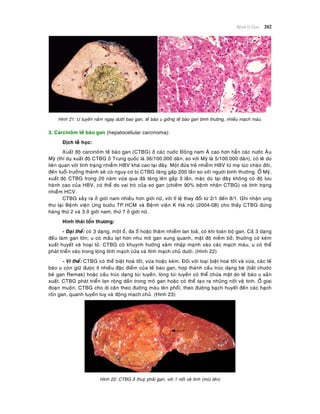 Beänh lyù Gan 202
Hình 21: U tuyeán naèm ngay döôùi bao gan, teá baøo u gioáng teá baøo gan bình thöôøng, nhieàu maïch maùu.
3. Carcinoâm teá baøo gan (hepatocellular carcinoma):
Dòch teã hoïc:
Xuaát ñoä carcinoâm teá baøo gan (CTBG) ôû caùc nöôùc Ñoâng nam AÙ cao hôn haún caùc nöôùc AÂu
Myõ (thí duï xuaát ñoä CTBG ôû Trung quoác laø 36/100.000 daân, so vôùi Myõ laø 5/100.000 daân), coù leõ do
lieân quan vôùi tình traïng nhieãm HBV khaù cao taïi ñaây. Moät ñöùa treû nhieãm HBV töø meï luùc chaøo ñôøi,
ñeán tuoåi tröôûng thaønh seõ coù nguy cô bò CTBG taêng gaáp 200 laàn so vôùi ngöôøi bình thöôøng. ÔÛ Myõ,
xuaát ñoä CTBG trong 20 naêm vöøa qua ñaõ taêng leân gaáp 3 laàn, maëc duø taïi ñaây khoâng coù ñoä löu
haønh cao cuûa HBV, coù theå do vai troø cuûa xô gan (chieám 90% beänh nhaân CTBG) vaø tình traïng
nhieãm HCV.
CTBG xaûy ra ôû giôùi nam nhieàu hôn giôùi nöõ, vôùi tæ leä thay ñoåi töø 2/1 ñeán 8/1. Ghi nhaän ung
thö taïi Beänh vieän Ung böôùu TP.HCM vaø Beänh vieän K Haø noäi (2004-08) cho thaáy CTBG ñöùng
haøng thöù 2 vaø 3 ôû giôùi nam, thöù 7 ôû giôùi nöõ.
Hình thaùi toån thöông:
- Ñaïi theå: coù 3 daïng, moät oå, ña oå hoaëc thaâm nhieãm lan toaû, coù khi toaøn boä gan. Caû 3 daïng
ñeàu laøm gan lôùn; u coù maàu laït hôn nhu moâ gan xung quanh, maät ñoä meàm bôû, thöôøng coù keøm
xuaát huyeát vaø hoaïi töû. CTBG coù khuynh höôùng xaâm nhaäp maïnh vaøo caùc maïch maùu, u coù theå
phaùt trieån vaøo trong loøng tónh maïch cöûa vaø tónh maïch chuû döôùi. (Hình 22)
- Vi theå: CTBG coù theå bieät hoaù toát, vöøa hoaëc keùm. Ñoái vôùi loaïi bieät hoaù toát vaø vöøa, caùc teá
baøo u coøn giöõ ñöôïc ít nhieàu ñaëc ñieåm cuûa teá baøo gan, hôïp thaønh caáu truùc daïng beø (baét chöôùc
beø gan Remak) hoaëc caáu truùc daïng tuùi tuyeán, loøng tuùi tuyeán coù theå chöùa maät do teá baøo u saûn
xuaát. CTBG phaùt trieån lan roäng daàn trong moâ gan hoaëc coù theå taïo ra nhöõng noát veä tinh. ÔÛ giai
ñoaïn muoän, CTBG cho di caên theo ñöôøng maùu leân phoåi, theo ñöôøng baïch huyeát ñeán caùc haïch
roán gan, quanh tuyeán tuî vaø ñoäng maïch chuû. (Hình 23)
Hình 22: CTBG ôû thuyø phaûi gan, vôùi 1 noát veä tinh (muõi teân)
 