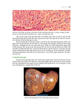 Beänh lyù Gan 203
Hình 23: Vi theå CTBG, caùc teá baøo u taïo thaønh tuùi tuyeán trong loøng chöùa maät (1), teá baøo u dò daïng, coù phaân
baøo (2) so vôùi teá baøo gan bình thöôøng (3) (A); teá baøo u taïo thaønh beø (4) (B).
Lieân heä laâm saøng: trong giai ñoaïn ñaàu cuûa CTBG, beänh nhaân coù theå coù moät soá trieäu
chöùng khoâng ñaëc hieäu nhö ñau laâm raâm vuøng haï söôøn phaûi, caûm giaùc khoù ôû, meät moûi, suït caân,
Khi u ñaõ lôùn, coù theå sôø thaáy gan to, chaéc.
Do hieän töôïng giaûi öùc cheá gen, teá baøo u coù theå taùi saûn xuaát alpha fetoprotein (AFP); moät
beänh nhaân maø keát quaû sieâu aâm cho thaáy coù 1 khoái choaùn choã trong gan, keát hôïp vôùi haøm löôïng
AFP/maùu > 500ng/ml thì haàu nhö chaéc chaén ñoù laø CTBG; tuy nhieân khoaûng 20% beänh nhaân
CTBG khoâng coù AFP taêng, do ñoù moät keát quaû AFP aâm tính thì chöa ñuû ñeå loaïi tröø CTBG. Keát
quaû ñieàu trò CTBG raát khieâm toán, vì ña soá khi phaùt hieän thì u ñaõ lôùn hoaëc do u xuaát hieän treân neàn
xô gan, khoâng theå chæ ñònh phaãu thuaät; hoaù trò vaø xaï trò khoâng coù vai troø trong ñieàu trò CTBG.
Tieân löôïng soáng theâm 5 naêm ñoái vôùi u coù kích thöôùc 2 - 5cm laø 40%, giaûm xuoáng coøn 10% ñoái u
lôùn hôn 5 cm.
4. Ung thö di caên gan
Ung thö di caên gan gaëp nhieàu hôn ung thö gan nguyeân phaùt. Ung thö cuûa baát kyø nôi naøo
trong cô theå cuõng coù theå di caên ñeán gan, nhöng thöôøng gaëp nhaát laø caùc di caên töø ung thö ñöôøng
tieâu hoaù. Daïng ñaïi theå cuûa ung thö di caên thöôøng laø toån thöông ña oå, ôû caû 2 thuyø gan, coù caáu
taïo vi theå gioáng nhö u nguyeân phaùt. (Hình 24)
Hình 24: Toån thöông ña oå, ôû caû 2 thuyø trong ung thö di caên gan
 