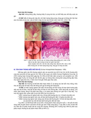 206Beänh lyù heä Sinh duïc nöõ
Hình thaùi toån thöông:
- Ñaïi theå: maûng traéng, daày, thöôøng thaáy ôû vuøng moâi lôùn; coù theå thaáy caùc veát traày xöôùc do
gaõi.
- Vi theå: bieåu bì taêng saûn daøy leân vôùi hieän töôïng taêng söøng, taêng gai vaø taêng saûn lôùp haït;
caùc nhuù bieåu bì keùo daøi. Lôùp bì thaám nhaäp raûi raùc caùc teá baøo vieâm maõn tính. (Hình 1B)
Hình 1: Liken xô hoaù, moâi lôùn teo, coù nhöõng maûng traéng phaúng (A1); treân vi theå,
bieåu bì teo ñeùt, lôùp bì noâng xô hoaù vaø hyalin hoaù (A2).
Liken simplex maõn tính, moâi lôùn maàu traéng nhaït, daày leân (B1); treân vi theå,
bieåu bì taêng saûn vôùi hieän töôïng taêng söøng, taêng gai vaø taêng haït (B2)
III. TAÂN SINH TRONG BIEÅU MOÂ AÂM HOÄ (Vulvar Intraepithelial Neoplasia - VIN):
VIN bao goàm caùc toån thöông nghòch saûn vaø carcinoâm taïi choã ôû aâm hoä, laø toån thöông tieàn
ung cuûa carcinoâm teá baøo gai aâm hoä. VIN coù lieân quan vôùi nhieãm Human Papilloma Virus tyùp 16
(70% tröôøng hôïp) nhöng hieám gaëp tyùp 18; VIN coù theå hieäân dieän cuøng luùc vôùi condyloâm suøi. VIN
thöôøng gaëp ôû phuï nöõ trong ñoä tuoåi 35-40; gaây ra nhöõng trieäu chöùng laâm saøng khoâng ñaëc hieäu
nhö ngöùa ngaùy khoù chòu, ræ dòch chuùt ít do gaõi nhieàu gaây traày xöôùc.
Hình thaùi toån thöông:
- Ñaïi theå: toån thöông coù theå ñôn ñoäc hoaëc nhieàu oå, coù daïng caùc daùt saån maøu traéng, maàu
naâu do taêng saéc toá hoaëc maàu ñoû hoàng (coøn goïi laø hoàng saûn Queyrat).
- Vi theå: coù hieän töôïng nghòch saûn bieåu moâ laùt taàng vôùi tình traïng roái loaïn ñònh höôùng saéùp
xeáp caùc lôùp teá baøo, maät ñoä teá baøo taêng, teá baøo to nhoû khoâng ñeàu, nhaân taêng saéc dò daïng, tæ leä
nhaân /baøo töông, taêng tæ leä phaân baøo taêng, vò trí phaân baøo khoâng coøn giôùi haïn ôû lôùp ñaùy. Tuyø
möùc ñoä nghòch saûn, phaân bieät 3 möùc ñoä VIN ôû aâm hoä (Hình 2):
* VIN1: töông öùng vôùi nghòch saûn nheï, teá baøo baát thöôøngï khu truù 1/3 döôùi cuûa bieåu moâ.
* VIN2: töông öùng nghòch saûn vöøa, teá baøo baát thöôøngï leân ñeán 1/3 giöõa cuûa bieåu moâ.
* VIN3: töông öùng nghòch saûn naëng (caùc teá baøo baát thöôøng leân 1/3 treân beà daøy bieåu moâ)
vaø carcinoâm taïi choã (teá baøo baát thöôøng leân ñeán beà maët).
Tuy VIN 1 coù theå thoaùi trieån vaø töï khoûi, nhöng beänh nhaân caøng lôùn tuoåi ( > 45 tuoåi) thì khaû
naêng VIN chuyeån thaønh carcinoâm teá baøo gai xaâm nhaäp caøng taêng; vì vaäy ñieàu trò tieâu chuaån ñoái
vôùi VIN vaãn laø phaãu thuaät caét boû vuøng toån thöông. Khoaûng 25% tröôøng hôïp VIN taùi phaùt sau
phaãu thuaät, thöôøng laø caùc beänh nhaân VIN coù HPV (+).
 