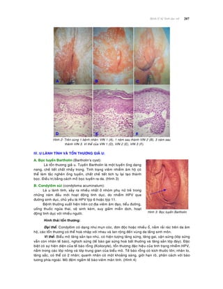 207Beänh lyù heä Sinh duïc nöõ
Hình 2: Treân cuøng 1 beänh nhaân: VIN 1 (A), 1 naêm sau thaønh VIN 2 (B), 3 naêm sau
thaønh VIN 3. Vi theå cuûa VIN 1 (D), VIN 2 (E), VIN 3 (F).
IV. U LAØNH TÍNH VAØ TOÅN THÖÔNG GIAÛ U:
A. Boïc tuyeán Bartholin (Bartholin’s cyst):
Laø toån thöông giaû u. Tuyeán Bartholin laø moät tuyeán oáng daïng
nang, cheá tieát chaát nhaày trong. Tình traïng vieâm nhieãm aâm hoä coù
theå laøm taéc ngheõn oáng tuyeán, chaát cheá tieát tích tuï laïi taïo thaønh
boïc. Ñieàu trò baèng caùch môû boïc tuyeán ra da. (Hình 3)
B. Condyloâm suøi (condyloma acuminatum):
Laø u laønh tính, xaûy ra nhieàu nhaát ôû nhoùm phuï nöõ treû trong
nhöõng naêm ñaàu môùi hoaït ñoäng tình duïc, do nhieãm HPV qua
ñöôøng sinh duïc, chuû yeáu laø HPV tyùp 6 hoaëc tyùp 11.
Beänh thöôøng xuaát hieän treân cô ñòa vieâm aâm ñaïo, tieåu ñöôøng,
uoáng thuoác ngöøa thai, veä sinh keùm, suy giaûm mieãn dòch, hoaït
ñoäng tình duïc vôùi nhieàu ngöôøi. Hình 3: Boïc tuyeán Bartholin
Hình thaùi toån thöông:
Ñaïi theå: Condyloâm coù daïng nhö muïn coùc, ñôn ñoäc hoaëc nhieàu oå, naèm raûi raùc treân da aâm
hoä, caùc toån thöông coù theå hoaø nhaäp vôùi nhau vaø lan roäng ñeán vuøng da taàng sinh moân.
Vi theå: Bieåu moâ taêng saûn taïo nhuù, coù hieän töôïng taêng söøng, taêng gai, caän söøng (lôùp söøng
vaãn coøn nhaân teá baøo), nghòch söøng (teá baøo gai söøng hoaù baát thöôøng vaø taêng saûn lôùp ñaùy). Ñaëc
bieät coù söï hieän dieän cuûa teá baøo roãng (Koilocyte), toån thöông ñaëc hieäu cuûa tình traïng nhieãm HPV,
naèm trong caùc lôùp noâng vaø lôùp trung gian cuûa bieåu moâ. Teá baøo roãng coù kích thöôùc lôùn; nhaân to,
taêng saéc, coù theå coù 2 nhaân; quanh nhaân coù moät khoaûng saùng, giôùi haïn roõ, phaân caùch vôùi baøo
töông phía ngoaøi. Moâ ñeäm ngaám teá baøo vieâm maõn tính. (Hình 4)
 