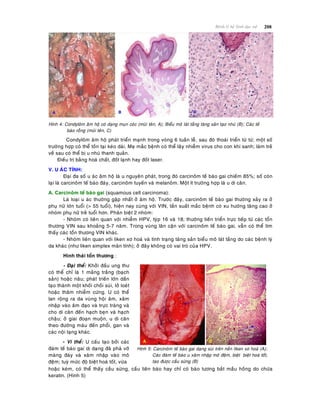208Beänh lyù heä Sinh duïc nöõ
Hình 4: Condyloâm aâm hoä coù daïng muïn coùc (muõi teân, A); Bieåu moâ laùt taàng taêng saûn taïo nhuù (B); Caùc teá
baøo roãng (muõi teân, C)
Condyloâm aâm hoä phaùt trieån maïnh trong voøng 6 tuaàn leã, sau ñoù thoaùi trieån töø töø; moät soá
tröôøng hôïp coù theå toàn taïi keùo daøi. Meï maéc beänh coù theå laây nhieãm virus cho con khi sanh; laøm treû
veà sau coù theå bò u nhuù thanh quaûn.
Ñieàu trò baèng hoaù chaát, ñoát laïnh hay ñoát laser.
V. U AÙC TÍNH:
Ñaïi ña soá u aùc aâm hoä laø u nguyeân phaùt, trong ñoù carcinoâm teá baøo gai chieám 85%; soá coøn
laïi laø carcinoâm teá baøo ñaùy, carcinoâm tuyeán vaø melanoâm. Moät ít tröôøng hôïp laø u di caên.
A. Carcinoâm teá baøo gai (squamous cell carcinoma):
Laø loaïi u aùc thöôøng gaëp nhaát ôû aâm hoä. Tröôùc ñaây, carcinoâm teá baøo gai thöôøng xaûy ra ôû
phuï nöõ lôùn tuoåi (> 55 tuoåi), hieän nay cuøng vôùi VIN, taàn suaát maéc beänh coù xu höôùng taêng cao ôû
nhoùm phuï nöõ treû tuoåi hôn. Phaân bieät 2 nhoùm:
- Nhoùm coù lieân quan vôùi nhieãm HPV, tyùp 16 vaø 18; thöôøng tieán trieån tröïc tieáp töø caùc toån
thöông VIN sau khoaûng 5-7 naêm. Trong vuøng laân caän vôùi carcinoâm teá baøo gai, vaãn coù theå tìm
thaáy caùc toån thöông VIN khaùc.
- Nhoùm lieân quan vôùi liken xô hoaù vaø tình traïng taêng saûn bieåu moâ laùt taàng do caùc beänh lyù
da khaùc (nhö liken simplex maõn tính); ôû ñaây khoâng coù vai troø cuûa HPV.
Hình thaùi toån thöông :
- Ñaïi theå: Khôûi ñaàu ung thö
coù theå chæ laø 1 maûng traéng (baïch
saûn) hoaëc naâu; phaùt trieán lôùn daàn
taïo thaønh moät khoái choài suøi, lôû loeùt
hoaëc thaâm nhieãm cöùng. U coù theå
lan roäng ra da vuøng hoäi aâm, xaâm
nhaäp vaøo aâm ñaïo vaø tröïc traøng vaø
cho di caên ñeán haïch beïn vaø haïch
chaäu; ôû giai ñoaïn muoän, u di caên
theo ñöôøng maùu ñeán phoåi, gan vaø
caùc noäi taïng khaùc.
- Vi theå: U caáu taïo bôûi caùc
ñaùm teá baøo gai dò daïng ñaõ phaù vôõ
maøng ñaùy vaø xaâm nhaäp vaøo moâ
ñeäm; tuyø möùc ñoä bieät hoaù toát, vöøa
Hình 5: Carcinoâm teá baøo gai daïng suøi treân neàn liken xô hoaù (A);
Caùc ñaùm teá baøo u xaâm nhaäp moâ ñeäm, bieät bieät hoaù toát,
taïo ñöôïc caàu söøng (B)
hoaëc keùm, coù theå thaáy caàu söøng, caàu lieân baøo hay chæ coù baøo töông baét maàu hoàng do chöùa
keratin. (Hình 5)
 