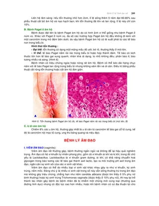 209Beänh lyù heä Sinh duïc nöõ
Lieân heä laâm saøng: neáu toån thöông nhoû hôn 2cm, tæ leä soáng theâm 5 naêm ñaït 60-80% sau
phaãu thuaät caét boû aâm hoä vaø naïo haïch beïn; khi toån thöông ñaõ lôùn vaø lan roäng, tæ leä naøy chæ coøn
10%.
B. Beänh Paget ôû aâm hoä
Beänh ñöôïc ñaët teân laø beänh Paget aâm hoä do coù hình aûnh vi theå gioáng nhö beänh Paget ôû
nuùm vuù. Khaùc vôùi Paget ôû nuùm vuù, ña soá caùc tröôøng hôïp Paget aâm hoä ñeàu khoâng ñi keøm vôùi
moät carcinoâm trong moâ ñeäm beân döôùi; do vaäy beänh Paget aâm hoä coù leõ xuaát phaùt töø caùc teá baøo
non trong bieåu bì.
Hình thaùi toån thöông :
- Ñaïi theå: toån thöông coù daïng moät maûng maàu ñoû öôùt, bôø roõ, thöôøng thaáy ôû moâi lôùn.
- Vi theå: teá baøo Paget naèm raûi raùc trong bieåu bì hoaëc hôïp thaønh ñaùm. Teá baøo coù kích
thöôùc lôùn hôn teá baøo gai xung quanh; nhaân khaù dò daïng, to nhoû khoâng ñeàu; phaân baøo ít; baøo
töông nhieàu vaø saùng. (Hình 6)
Beänh nhaân coù trieäu chöùng ngöùa hoaëc noùng raùt aâm hoä. Beänh coù theå keùo daøi haøng chuïc
naêm vôùi teá baøo Paget lan roäng trong bieåu bì nhöng khoâng xaâm laán vaø di caên. Ñieàu trò baèng phaãu
thuaät caét roäng toån thöông hoaëc caét aâm hoä ñôn giaûn.
Hình 6: Toån thöông beänh Paget aâm hoä (A), teá baøo Paget naèm raûi raùc trong bieåu bì (muõi teân, B)
C. U di caên aâm hoä
Chieám 8% caùc u aâm hoä, thöôøng gaëp nhaát laø u di caên töø carcinoâm teá baøo gai coå töû cung, keá
ñoù laø carcinoâm noäi maïc töû cung, ung thö baøng quang vaø nieäu ñaïo.
BEÄNH LYÙ AÂM ÑAÏO
I. VIEÂM AÂM ÑAÏO (vaginitis):
Vieâm aâm ñaïo raát thöôøng gaëp, beänh thöôøng ngaén nguûi vaø khoâng ñeå laïi haäu quaû nghieâm
troïng. AÂm ñaïo coù heä vi khuaån töï nhieân phong phuù, goàm caû vi khuaån aùi khí vaø kò khí, trong ñoù chuû
yeáu laø Lactobacillus. Lactobacillus laø vi khuaån gram döông, aùi khí, coù khaû naêng chuyeån hoaù
glycogen trong baøo töông caùc teá baøo gai thaønh axit lactic, taïo ra moâi tröôøng pH axit trong aâm
ñaïo, ngaên caûn söï sinh soâi cuûa caùc vi sinh vaät khaùc.
Vieâm aâm ñaïo coù theå do nhieàu loaïi vi sinh vaät khaùc nhau gaây ra nhö vi khuaån, kyù sinh
truøng, naám moác. Ñaùng chuù yù laø nhieàu vi sinh vaät trong soá naøy vaãn soáng thöôøng truù trong aâm ñaïo
maø khoâng gaây trieäu chöùng, chaúng haïn nhö naám candida albicans (ñöôïc tìm thaáy ôû 5% phuï nöõ
bình thöôøng) hoaëc kyù sinh truøng Trichomonas vaginalis (ñöôïc thaáy ôû 10% phuï nöõ), thì nay laïi trôû
thaønh taùc nhaân gaây beänh do beänh nhaân ñaõ bò nhieãm moät chuûng môùi cuøng loaïi (thöôøng qua
ñöôøng tình duïc) nhöng coù ñoäc löïc cao hôn nhieàu; hoaëc khi beänh nhaân coù cô ñòa thuaän lôïi cho
 