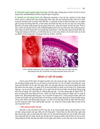 211Beänh lyù heä Sinh duïc nöõ
B. Carcinoâm tuyeán nguyeân phaùt ôû aâm ñaïo: raát hieám gaëp, thöôøng xaûy ra ôû phuï nöõ treû coù meï söû
duïng thuoác diethylstilbestrol (DES) trong thôøi gian mang thai.
C. Sarcoâm cô vaân daïng chuøm nho (Botryoid sarcoma): ôû caùc beù gaùi, sarcoâm cô vaân daïng
chuøm nho laø u ñuôøng sinh duïc thöôøng gaëp nhaát. Haàu heát caùc tröôøng hôïp ñeàu nhoû hôn 5 tuoåi,
trong ñoù 2/3 beänh xaûy ra trong 2 naèm ñaàu ñôøi. U xuaát phaùt töø lôùp moâ ñeäm saùt bieåu moâ, coù nguoàn
goác töø trung moâ khoâng bieät hoùa. U xaâm nhaäp vaøo thaønh aâm ñaïo vaø vaøo caùc caáu truùc vuøng chaäu.
Ñaïi theå u coù daïng nhieàu polyp hôïp laïi gioáng chuøm nho, nhaày nhö thaïch, sa khoûi aâm ñaïo. Treân vi
theå, u goàm caùc nguyeân baøo cô vaân (rhabdomyoblast) hình troøn hay hình thoi, baøo töông öa eosin,
naèm trong moâ ñeäm daïng nieâm vaø thöôøng taäp trung thaønh 1 lôùp daøy ñaëc ngay saùt döôùi bieåu moâ.
Trong baøo töông cuûa teá baøo u coù theå thaáy vaân cô. U lan roäng nhanh, cho di caên haïch vaø di caên
xa. Beänh coù tieân löôïng xaáu, tæ leä soáng 5 naêm laø 10-35%. (hình 8)
Hình 8: Sarcoâm daïng chuøm nho, sa khoûi aâm ñaïo (A) Teá baøo hình troøn hoaëc hình thoi,
baøo töông aùi toan (B), coø theå thaáy vaân ngang trong baøo töông (hình nhoû)
BEÄNH LYÙ COÅ TÖÛ CUNG
Coå töû cung (CTC) goàm coå ngoaøi laø phaàn nhoâ vaøo trong aâm ñaïo, ñöôïc bao phuû bôûi bieåu
moâ laùt taàng khoâng söøng hoùa vaø coå trong laø moät oáng hình truï noái coå ngoaøi vôùi buoàng töû cung,
ñöôïc phuû bôûi bieåu moâ truï ñôn tieát nhaày, bieåu moâ naøy gaáp neáp saâu vaøo trong moâ ñeäm beân döôùi
taïo thaønh caùc khe tuyeán. Loã ngoaøi CTC laø ranh giôùi giöõa coå ngoaøi vaø coå trong CTC. Ñöôøng tieáp
hôïp gai - truï laø nôi noái tieáp giöõa bieåu moâ truï ñôn cuûa coå trong vôùi bieåu moâ laùt taàng khoâng söøng
hoùa cuûa coå ngoaøi. Khi chöa daäy thì, ñöôøng tieáp hôïp gai - truï naèm ñuùng ngay loã ngoaøi CTC. ÔÛ
phuï nöõ trong tuoåi hoaït ñoäng sinh duïc, tuyeán coå trong lan daàn xuoáng coå ngoaøi, taïo ra vuøng loä
tuyeán CTC, ñaåy ñöôøng tieáp hôïp gai - truï ra xa khoûi loã ngoaøi CTC. Trong vuøng loä tuyeán, bieåu moâ
truï ñôn seõ chuyeån saûn gai thaønh bieåu moâ laùt taàng; vuøng loä tuyeán ñöôïc goïi laø vuøng chuyeån daïng,
vôùi söï hình thaønh moät ñöôøng tieáp hôïp gai - truï môùi ôû vò trí ban ñaàu (Hình 9). Ñeán tuoåi maõn kinh,
do tình traïng teo nieâm maïc, ñöôøng tieáp hôïp gai - truï cuøng vôùi vuøng chuyeån tieáp tuït saâu trôû laïi
vaøo trong keânh CTC.
* Hieän töôïng chuyeån saûn gai
Ñeå hieåu vì sao caùc beänh lyù CTC hay xaûy ra taïi vuøng chuyeån daïng, caàn phaûi hieåu roõ hôn
veà hieän töôïng chuyeån saûn gai. Bieåu moâ coå trong goàm 1 lôùp teá baøo truï ñôn tieát nhaày; giöõa maët
ñaùy cuûa teá baøo naøy vaø maøng ñaùy beân döôùi coøn coù moät lôùp khoâng lieân tuïc caùc teá baøo nhoû nhaân
troøn töông ñoái khoù tìm thaáy, goïi laø caùc teá baøo döï tröõ (reserve cells). Caùc teá baøo döï tröõ coù chöùc
naêng töông töï teá baøo lôùp ñaùy cuûa bieåu moâ coå ngoaøi, giöõ nhieäm vuï sinh saûn taïo ra caùc teá baøo truï
 