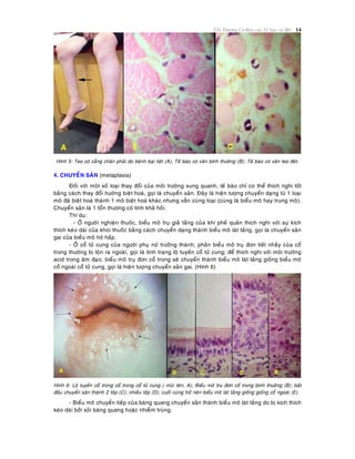 Toån Thöông Cô Baûn cuûa Teá baøo vaø Moâ 14
Hình 5: Teo cô caúng chaân phaûi do beänh baïi lieät (A); Teá baøo cô vaân bình thöôøng (B); Teá baøo cô vaân teo ñeùt.
4. CHUYEÅN SAÛN (metaplasia)
Ñoái vôùi moät soá loaïi thay ñoåi cuûa moâi tröôøng xung quanh, teá baøo chæ coù theå thích nghi toát
baèng caùch thay ñoåi höôùng bieät hoaù, goïi laø chuyeån saûn. Ñaây laø hieän töôïng chuyeån daïng töø 1 loaïi
moâ ñaõ bieät hoaù thaønh 1 moâ bieät hoaù khaùc nhöng vaãn cuøng loaïi (cuøng laø bieåu moâ hay trung moâ).
Chuyeån saûn laø 1 toån thöông coù tính khaû hoài.
Thí duï:
- ÔÛ ngöôøi nghieän thuoác, bieåu moâ truï giaû taàng cuûa khí pheá quaûn thích nghi vôùi söï kích
thích keùo daøi cuûa khoùi thuoác baèng caùch chuyeån daïng thaønh bieåu moâ laùt taàng, goïi laø chuyeån saûn
gai cuûa bieåu moâ hoâ haáp.
- ÔÛ coå töû cung cuûa ngöôøi phuï nöõ tröôûng thaønh, phaàn bieåu moâ truï ñôn tieát nhaày cuûa coå
trong thöôøng bò loän ra ngoaøi, goïi laø tình traïng loä tuyeán coå töû cung; ñeå thích nghi vôùi moâi tröôøng
acid trong aâm ñaïo, bieåu moâ truï ñôn coå trong seõ chuyeån thaønh bieåu moâ laùt taàng gioáng bieåu moâ
coå ngoaøi coå töû cung, goïi laø hieän töôïng chuyeån saûn gai. (Hình 6)
Hình 6: Loä tuyeán coå trong coå trong coå töû cung ( muõi teân, A); Bieåu moâ truï ñôn coå trong bình thöôøng (B); baét
ñaàu chuyeån saûn thaønh 2 lôùp (C); nhieàu lôùp (D); cuoái cuøng trôû neân bieåu moâ laùt taàng gioáng gioáng coå ngoaøi (E).
- Bieåu moâ chuyeån tieáp cuûa baøng quang chuyeån saûn thaønh bieåu moâ laùt taàng do bò kích thích
keùo daøi bôûi soûi baøng quang hoaëc nhieãm truøng.
 