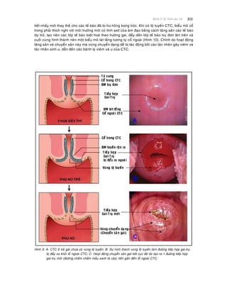 212Beänh lyù heä Sinh duïc nöõ
tieát nhaày môùi thay theá cho caùc teá baøo ñaõ bò hö hoûng bong troùc. Khi coù loä tuyeán CTC, bieåu moâ coå
trong phaûi thích nghi vôùi moâi tröôøng môùi coù tính axít cuûa aâm ñaïo baèng caùch taêng saûn caùc teá baøo
döï tröõ, taïo neân caùc lôùp teá baøo bieät hoaù theo höôùng gai, ñaåy daàn lôùp teá baøo truï ñôn leân treân vaø
cuoái cuøng hình thaønh neân moät bieåu moâ laùt taàng töông töï coå ngoaøi (Hình 10). Chính do hoaït ñoäng
taêng saûn vaø chuyeån saûn naøy maø vuøng chuyeån daïng deã bò taùc ñoäng bôûi caùc taùc nhaân gaây vieâm vaø
taùc nhaân sinh u, daãn ñeán caùc beänh lyù vieâm vaø u cuûa CTC.
Hình 9: A- CTC ôû treû gaùi chöa coù vuøng loä tuyeán; B- Söï hình thaønh vuøng loä tuyeán laøm ñöôøng tieáp hôïp gai-truï
bò ñaåy xa khoûi loã ngoaøi CTC; C- Hoaït ñoäng chuyeån saûn gai keát cuïc ñaõ taùi taïo ra 1 ñöôøng tieáp hôïp
gai-truï môùi (ñöôøng chaám chaám maàu xanh laù caây) tieán gaàn ñeán loã ngoaøi CTC.
 