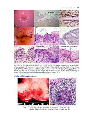 213Beänh lyù heä Sinh duïc nöõ
Hình 10: CTC bình thöôøng, ñöôøng tieáp hôïp gai - truï (muõi teân, A); Tieáp hôïp gai - truï döôùi kính hieån vi (B); Caùc
teá baøo döï tröõ baét maàu naâu (hoaù moâ mieãn dòch vôùi khaùng theå choáng KA) naèm döôùi lôùp teá baøo truï (C); Vuøng loä
tuyeán CTC maàu ñoû hôn, coù chöùa caùc ñaùm chuyeån saûn gai (muõi teân, D); Vuøng chuyeån daïng (E); Teá baøo döï
tröõ baét ñaàu taêng saûn (F); Caùc lôùp chuyeån saûn gai, ñaåy teá baøo truï leân treân (G, H); Vuøng chuyeån daïng ñaõ
chuyeån saûn gai hoaøn toaøn, trôû thaønh bieåu moâ laùt taàng gioáng coå ngoaøi CTC (I).
I. VIEÂM COÅ TÖÛ CUNG (cervicitis):
Hình 11: CTC bò vieâm maõn tính, sung huyeát ñoû (A), Treân vi theå, moâ ñeäm thaám
nhaäp caùc teá baøo vieâm maõn tính vaø coù söï hình thaønh nang limphoâ (B).
 
