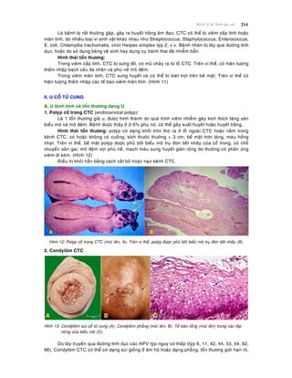 214Beänh lyù heä Sinh duïc nöõ
Laø beänh lyù raát thöôøng gaëp, gaây ra huyeát traéng aâm ñaïo. CTC coù theå bò vieâm caáp tính hoaëc
maõn tính, do nhieàu loaïi vi sinh vaät khaùc nhau nhö Streptococcus, Staphylococcus, Enterococcus,
E. coli, Chlamydia trachomatis, viruùt Herpes simplex tyùp 2, v.v. Beänh nhaân bò laây qua ñöôøng tình
duïc, hoaëc do söû duïng baêng veä sinh hay duïng cuï traùnh thai ñaõ nhieãm baån.
Hình thaùi toån thöông:
Trong vieâm caáp tính, CTC bò söng ñoû, coù muû chaûy ra töø loã CTC. Treân vi theå, coù hieän töôïng
thaám nhaäp baïch caàu ña nhaân vaø phuø neà moâ ñeäm.
Trong vieâm maõn tính, CTC sung huyeát vaø coù theå bò loeùt trôït treân beà maët. Treân vi theå coù
hieän töôïng thaám nhaäp caùc teá baøo vieâm maõn tính. (Hình 11)
II. U COÅ TÖÛ CUNG
A. U laønh tính vaø toån thöông daïng U
1. Polyùp coå trong CTC (endocervical polyp):
Laø 1 toån thöông giaû u, ñöôïc hình thaønh do quaù trình vieâm nhieãm gaây kích thích taêng saûn
bieåu moâ vaø moâ ñeäm. Beänh ñöôïc thaáy ôû 2-5% phuï nöõ, coù theå gaây xuaát huyeát hoaëc huyeát traéng.
Hình thaùi toån thöông: polyùp coù daïng khoái troøn thoø ra ôû loã ngoaøi CTC hoaëc naèm trong
keânh CTC, coù hoaëc khoâng coù cuoáng; kích thöôùc thöôøng < 3 cm; beà maët trôn laùng, maøu hoàng
nhaït. Treân vi theå, beà maët polyùp ñöôïc phuû bôûi bieåu moâ truï ñôn tieát nhaày cuûa coå trong, coù choã
chuyeån saûn gai; moâ ñeäm sôïi phuø neà, maïch maùu sung huyeát giaõn roäng do thöôøng coù phaûn öùng
vieâm ñi keøm. (Hình 12)
Ñieàu trò khoûi haún baèng caùch caét boû hoaëc naïo keânh CTC.
Hình 12: Polyp coå trong CTC (muõi teân, A); Treân vi theå, polyùp ñöôïc phuû bôûi bieåu moâ truï ñôn tieát nhaày (B).
2. Condyloâm CTC
Hình 13: Condyloâm suøi coå töû cung (A); Condyloâm phaúng (muõi teân, B); Teá baøo roãng (muõi teân) trong caùc lôùp
noâng cuûa bieåu moâ (C).
Do laây truyeàn qua ñöôøng tình duïc caùc HPV tyùp nguy cô thaáp (tyùp 6, 11, 42, 44, 53, 54, 62,
66). Condyloâm CTC coù theå coù daïng suøi gioáng ôû aâm hoä hoaëc daïng phaúng, toån thöông giôùi haïn roõ,
 