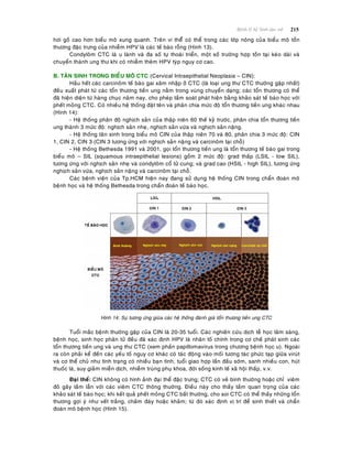 215Beänh lyù heä Sinh duïc nöõ
hôi goà cao hôn bieåu moâ xung quanh. Treân vi theåå coù theå trong caùc lôùp noâng cuûa bieåu moâ toån
thöông ñaëc tröng cuûa nhieãm HPV laø caùc teá baøo roãng (Hình 13).
Condyloâm CTC laø u laønh vaø ña soá töï thoaùi trieån, moät soá tröôøng hôïp toàn taïi keùo daøi vaø
chuyeån thaønh ung thö khi coù nhieãm theâm HPV tyùp nguy cô cao.
B. TAÂN SINH TRONG BIEÅU MOÂ CTC (Cervical Intraepithelial Neoplasia – CIN):
Haàu heát caùc carcinoâm teá baøo gai xaâm nhaäp ôû CTC (laø loaïi ung thö CTC thöôøng gaëp nhaát)
ñeàu xuaát phaùt töø caùc toån thöông tieàn ung naèm trong vuøng chuyeån daïng; caùc toån thöông coù theå
ñaõ hieän dieän töø haøng chuïc naêm nay, cho pheùp taàm soaùt phaùt hieän baèng khaûo saùt teá baøo hoïc vôùi
pheát moûng CTC. Coù nhieàu heä thoáng ñaët teân vaø phaân chia möùc ñoä toån thöông tieàn ung khaùc nhau
(Hình 14):
- Heä thoáng phaân ñoä nghòch saûn cuûa thaäp nieân 60 theá kyû tröôùc, phaân chia toån thöông tieàn
ung thaønh 3 möùc ñoä: nghòch saûn nheï, nghòch saûn vöøa vaø nghòch saûn naëng.
- Heä thoáng taân sinh trong bieåu moâ CIN cuûa thaäp nieân 70 vaø 80, phaân chia 3 möùc ñoä: CIN
1, CIN 2, CIN 3 (CIN 3 töông öùng vôùi nghòch saûn naëng vaø carcinoâm taïi choã)
- Heä thoáng Bethesda 1991 vaø 2001, goïi toån thöông tieàn ung laø toån thöông teá baøo gai trong
bieåu moâ – SIL (squamous intraepithelial lesions) goàm 2 möùc ñoä: grad thaáp (LSIL - low SIL),
töông öùng vôùi nghòch saûn nheï vaø condyloâm coå töû cung; vaø grad cao (HSIL - high SIL), töông öùng
nghòch saûn vöøa, nghòch saûn naëng vaø carcinoâm taïi choã.
Caùc beänh vieän cuûa Tp.HCM hieän nay ñang söû duïng heä thoáng CIN trong chaån ñoaùn moâ
beänh hoïc vaø heä thoáng Bethesda trong chaån ñoaùn teá baøo hoïc.
Hình 14: Söï töông öùng giuõa caùc heä thoáng ñaùnh giaù toån thöông tieàn ung CTC
Tuoåi maéc beänh thöôøng gaëp cuûa CIN laø 20-35 tuoåi. Caùc nghieân cöùu dòch teã hoïc laâm saøng,
beänh hoïc, sinh hoïc phaân töû ñeàu ñaõ xaùc ñònh HPV laø nhaân toá chính trong cô cheá phaùt sinh caùc
toån thöông tieàn ung vaø ung thö CTC (xem phaàn papillomavirus trong chöông beänh hoïc u). Ngoaøi
ra coøn phaûi keå ñeán caùc yeáu toá nguy cô khaùc coù taùc ñoäng vaøo moái töông taùc phöùc taïp giöõa viruùt
vaø cô theå chuû nhö tình traïng coù nhieàu baïn tình, tuoåi giao hôïp laàn ñaàu sôùm, sanh nhieàu con, huùt
thuoác laù, suy giaûm mieãn dòch, nhieãm truøng phuï khoa, ñôøi soáng kinh teá xaõ hoäi thaáp, v.v.
Ñaïi theå: CIN khoâng coù hình aûnh ñaïi theå ñaëc tröng; CTC coù veû bình thöôøng hoaëc chæ vieâm
ñoû gaây laàm laãn vôùi caùc vieâm CTC thoâng thöôøng. Ñieàu naøy cho thaáy taàm quan troïng cuûa caùc
khaûo saùt teá baøo hoïc; khi keát quaû pheát moûng CTC baát thöôøng, cho soi CTC coù theå thaáy nhöõng toån
thöông gôïi yù nhö veát traéng, chaám ñaùy hoaëc khaûm; töø ñoù xaùc ñònh vò trí ñeå sinh thieát vaø chaån
ñoaùn moâ beänh hoïc (Hình 15).
 