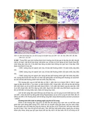 216Beänh lyù heä Sinh duïc nöõ
Hình 15: Hình aûnh teá baøo hoïc, soi coå töû cung vaø moâ beänh hoïc cuûa CIN 1 (A1, A2, A3), CIN 2 (B1, B2, B3),
CIN 3 (C1, C2, C3)
Vi theå: Trong CIN, quaù trình tröôûng thaønh bình thöôøng cuûa teá baøo gai töø lôùp ñaùy leân ñeán lôùp beà
maët bò roái loaïn: maät ñoä teá baøo taêng, maát phaân cöïc, teá baøo coù hình daïng vaø kích thöôùc thay ñoåi,
nhaân taêng saéc meùo moù, tæ leä phaân baøo taêng vaø phaân baøo khoâng coøn giôùi haïn ôû lôùp ñaùy. CIN
ñöôïc chia thaønh 3 möùc ñoä:
- CIN1: töông öùng vôùi nghòch saûn nheï, teá baøo baát thöôøng chieám 1/3 döôùi chieàu daøy bieåu
moâ.
- CIN2: töông öùng vôùi nghòch saûn vöøa, teá baøo baát thöôøng chieám 2/3 döôùi chieàu daøy bieåu
moâ.
- CIN3: töông öùng vôùi nghòch saûn naëng (teá baøo baát thöôøng chieám gaàn heát chieàu daøy bieåu
moâ, nhöng lôùp teá baøo beà maët vaãn coù nhaân deït gioáng bieåu moâ laùt taàng bình thöôøng) vaø carcinoâm
taïi choã (teá baøo baát thöôøng chieám toaøn boä chieàu daøy bieåu moâ).
Toån thöông tieàn ung coù theå baét ñaàu töø CIN 1, dieãn tieán töø töø thaønh CIN 2, CIN 3, hoaëc
ngay töø ñaàu ñaõ laø CIN 3. Tuy nhieân, coù ñeán 50-60% CIN 1 thoaùi trieån, 30% toàn taïi laâu daøi khoâng
tieán trieån theâm vaø chæ coù 20% tieán trieån thaønh CIN 3, 1-5% dieãn tieán thaønh ung thö xaâm laán. CIN
3 coù 33% thoaùi trieån, 60-74% tieáp tuïc tieán trieån. Quaù trình tieán trieån cuûa CIN thaønh ung thö xaâm
laán coù theå dieãn ra trong nhieàu naêm, thaäm chí haøng chuïc naêm.
Lieân heä laâm saøng: taàm soaùt CIN döïa vaøo teá baøo hoïc, soi töû cung vaø sinh thieát döôùi soi. Ñoái
vôùi CIN 1, theo doõi ñònh kyø baèng pheát moûng Papanicolaou vaø soi coå töû cung khi caàn thieát; ñoái vôùi
CIN 2 vaø CIN 3, toån thöông ñöôïc caét boû baèng voøng ñieän (loop electrocautery excision procedure
- LEEP).
Chöông trình taàm soaùt vaø phoøng ngöøa ung thö coå töû cung:
Chính vì toån thöông tieàn ung CTC coù theå keùo daøi haøng chuïc naêm neân coù theå taàm soaùt
phaùt hieän sôùm baèng pheát moûng CTC, tröôùc khi noù chuyeån sang giai ñoaïn ung thö xaâm nhaäp.
Theo khuyeán caùo cuûa Hieäp hoäi Ung thö Hoa kyø, ñoái vôùi phuï nöõ töø 18-40 tuoåi, caàn thöïc hieän ñònh
kyø moãi 3 naêm 1 laàn, treân 40 tuoåi thì moãi naêm 1 laàn. Ñeå thöïc hieän pheát moûng, ngöôøi phuï nöõ ñöôïc
khaùm phuï khoa, duøng que goã (que Ayre) ñeå caïo laáy moät ít teá baøo bieåu moâ töø coå trong vaø coå
 