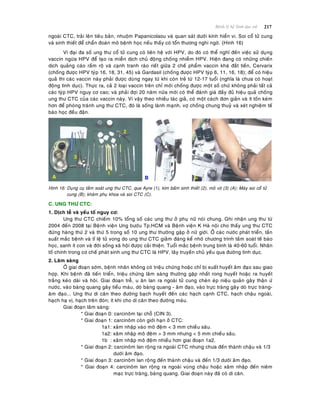217Beänh lyù heä Sinh duïc nöõ
ngoaøi CTC, traûi leân tieâu baûn, nhuoäm Papanicolaou vaø quan saùt döôùi kính hieån vi. Soi coå töû cung
vaø sinh thieát ñeå chaån ñoaùn moâ beänh hoïc neáu thaáy coù toån thöông nghi ngôø. (Hình 16)
Vì ñaïi ña soá ung thö coå töû cung coù lieân heä vôùi HPV, do ñoù coù theå nghó ñeán vieäc söû duïng
vaccin ngöøa HPV ñeå taïo ra mieãn dòch chuû ñoäng choáng nhieãm HPV. Hieän ñang coù nhöõng chieán
dòch quaûng caùo raàm roä vaø caïnh tranh raùo rieát giöõa 2 cheá phaåm vaccin khaù ñaét tieàn, Cervarix
(choáng ñöôïc HPV tyùp 16, 18, 31, 45) vaø Gardasil (choáng ñöôïc HPV tyùp 6, 11, 16, 18); ñeå coù hieäu
quaû thì caùc vaccin naøy phaûi ñöôïc duøng ngay töø khi coøn treû töø 12-17 tuoåi (nghóa laø chöa coù hoaït
ñoäng tình duïc). Thöïc ra, caû 2 loaïi vaccin treân chæ môùi choáng ñöôïc moät soá chöù khoâng phaûi taát caû
caùc tyùp HPV nguy cô cao; vaø phaûi ñôïi 20 naêm nöõa môùi coù theå ñaùnh giaù ñaày ñuû hieäu quaû choáng
ung thö CTC cuûa caùc vaccin naøy. Vì vaäy theo nhieàu taùc giaû, coù moät caùch ñôn giaûn vaø ít toán keùm
hôn ñeå phoøng traùnh ung thö CTC, ñoù laø soáng laønh maïnh, vôï choàng chung thuyû vaø xeùt nghieäm teá
baøo hoïc ñeàu ñaën.
Hình 16: Duïng cuï taàm soaùt ung thö CTC, que Ayre (1), kìm baám sinh thieát (2), moû vòt (3) (A); Maùy soi coå töû
cung (B); khaùm phuï khoa vaø soi CTC (C).
C. UNG THÖ CTC:
1. Dòch teã vaø yeáu toá nguy cô:
Ung thö CTC chieám 10% toång soá caùc ung thö ôû phuï nöõ noùi chung. Ghi nhaän ung thö töø
2004 ñeán 2008 taïi Beänh vieän Ung böôùu Tp.HCM vaø Beänh vieän K Haø noäi cho thaáy ung thö CTC
ñöùng haøng thöù 2 vaø thöù 5 trong soá 10 ung thö thöôøng gaëp ôû nöõ giôùi. ÔÛ caùc nöôùc phaùt trieån, taàn
suaát maéc beänh vaø tæ leä töû vong do ung thö CTC giaûm ñaùng keå nhôø chöông trình taàm soaùt teá baøo
hoïc, sanh ít con vaø ñôøi soáng xaõ hoäi ñöôïc caûi thieän. Tuoåi maéc beänh trung bình laø 40-60 tuoåi. Nhaân
toá chính trong cô cheá phaùt sinh ung thö CTC laø HPV, laây truyeàn chuû yeáu qua ñöôøng tình duïc.
2. Laâm saøng
ÔÛ giai ñoaïn sôùm, beänh nhaân khoâng coù trieäu chöùng hoaëc chæ bò xuaát huyeát aâm ñaïo sau giao
hôïp. Khi beänh ñaõ tieán trieån, trieäu chöùng laâm saøng thöôøng gaëp nhaát rong huyeát hoaëc ra huyeát
traéng keùo daøi vaø hoâi. Giai ñoaïn treã, u aên lan ra ngoaøi töû cung cheøn eùp nieäu quaûn gaây thaän öù
nöôùc, vaøo baøng quang gaây tieåu maùu, doø baøng quang - aâm ñaïo, vaøo tröïc traøng gaây doø tröïc traøng-
aâm ñaïo... Ung thö di caên theo ñöôøng baïch huyeát ñeán caùc haïch caïnh CTC, haïch chaäu ngoaøi,
haïch haï vò, haïch treân ñoøn; ít khi cho di caên theo ñöôøng maùu.
Giai ñoaïn laâm saøng:
* Giai ñoaïn 0: carcinoâm taïi choã (CIN 3).
* Giai ñoaïn 1: carcinoâm coøn giôùi haïn ôû CTC:
1a1: xaâm nhaäp vaøo moâ ñeäm < 3 mm chieàu saâu.
1a2: xaâm nhaäp moâ ñeäm > 3 mm nhöng < 5 mm chieàu saâu.
1b : xaâm nhaäp moâ ñeäm nhieàu hôn giai ñoaïn 1a2.
* Giai ñoaïn 2: carcinoâm lan roäng ra ngoaøi CTC nhöng chöa ñeán thaønh chaäu vaø 1/3
döôùi aâm ñaïo.
* Giai ñoaïn 3: carcinoâm lan roäng ñeán thaønh chaäu vaø ñeán 1/3 döôùi aâm ñaïo.
* Giai ñoaïn 4: carcinoâm lan roäng ra ngoaøi vuøng chaäu hoaëc xaâm nhaäp ñeán nieâm
maïc tröïc traøng, baøng quang. Giai ñoaïn naøy ñaõ coù di caên.
 