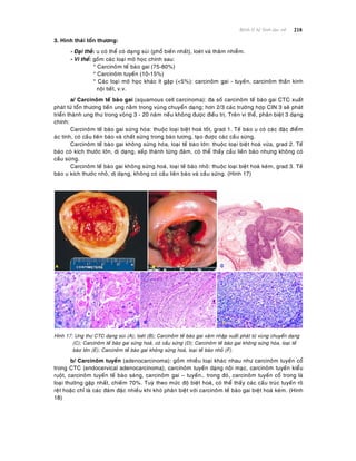 218Beänh lyù heä Sinh duïc nöõ
3. Hình thaùi toån thöông:
- Ñaïi theå: u coù theå coù daïng suøi (phoå bieán nhaát), loeùt vaø thaâm nhieãm.
- Vi theå: goàm caùc loaïi moâ hoïc chính sau:
* Carcinoâm teá baøo gai (75-80%)
* Carcinoâm tuyeán (10-15%)
* Caùc loaïi moâ hoïc khaùc ít gaëp (<5%): carcinoâm gai - tuyeán, carcinoâm thaàn kinh
noäi tieát, v.v.
a/ Carcinoâm teá baøo gai (squamous cell carcinoma): ña soá carcinoâm teá baøo gai CTC xuaát
phaùt töø toån thöông tieàn ung naèm trong vuøng chuyeån daïng; hôn 2/3 caùc tröôøng hôïp CIN 3 seõ phaùt
trieån thaønh ung thö trong voøng 3 - 20 naêm neáu khoâng ñöôïc ñieàu trò. Treân vi theå, phaân bieät 3 daïng
chính:
Carcinoâm teá baøo gai söøng hoùa: thuoäc loaïi bieät hoaù toát, grad 1. Teá baøo u coù caùc ñaëc ñieåm
aùc tính, coù caàu lieân baøo vaø chaát söøng trong baøo töông, taïo ñöôïc caùc caàu söøng.
Carcinoâm teá baøo gai khoâng söøng hoùa, loaïi teá baøo lôùn: thuoäc loaïi bieät hoaù vöøa, grad 2. Teá
baøo coù kích thöôùc lôùn, dò daïng, xeáp thaønh töøng ñaùm, coù theå thaáy caàu lieân baøo nhöng khoâng coù
caàu söøng.
Carcinoâm teá baøo gai khoâng söøng hoaù, loaïi teá baøo nhoû: thuoäc loaïi bieät hoaù keùm, grad 3. Teá
baøo u kích thöôùc nhoû, dò daïng, khoâng coù caàu lieân baøo vaø caàu söøng. (Hình 17)
Hình 17: Ung thö CTC daïng suøi (A); loeùt (B); Carcinoâm teá baøo gai xaâm nhaäp xuaát phaùt töø vuøng chuyeån daïng
(C); Carcinoâm teá baøo gai söøng hoaù, coù caàu söøng (D); Carcinoâm teá baøo gai khoâng söøng hoùa, loaïi teá
baøo lôùn (E); Carcinoâm teá baøo gai khoâng söøng hoaù, loaïi teá baøo nhoû (F).
b/ Carcinoâm tuyeán (adenocarcinoma): goàm nhieàu loaïi khaùc nhau nhö carcinoâm tuyeán coå
trong CTC (endocervical adenocarcinoma), carcinoâm tuyeán daïng noäi maïc, carcinoâm tuyeán kieåu
ruoät, carcinoâm tuyeán teá baøo saùng, carcinoâm gai – tuyeán… trong ñoù, carcinoâm tuyeán coå trong laø
loaïi thöôøng gaëp nhaát, chieám 70%. Tuyø theo möùc ñoä bieät hoaù, coù theå thaáy caùc caáu truùc tuyeán roõ
reät hoaëc chæ laø caùc ñaùm ñaëc nhieàu khi khoù phaân bieät vôùi carcinoâm teá baøo gai bieät hoaù keùm. (Hình
18)
 