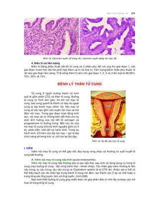 219Beänh lyù heä Sinh duïc nöõ
Hình 18: Carcinoâm tuyeán coå trong (A); Carcinoâm tuyeán daïng noäi maïc (B)
4. Ñieàu trò vaø tieân löôïng
Ñieàu trò baèng phaãu thuaät caét boû töû cung vaø 2 phaàn phuï ñoái vôùi ung thö giai ñoaïn 1, caùc
giai ñoaïn muoän hôn ñoøi hoûi phoái hôïp theâm xaï trò vaø hoaù trò. Tieân löôïng beänh nhaân phuï thuoäc roõ
reät vaøo giai ñoaïn laâm saøng. Tæ leä soáng theâm 5 naêm cho giai ñoaïn 1, 2, 3 vaø 4 laàn löôït laø 80-95%,
75%, 35% vaø 15%.
BEÄNH LYÙ THAÂN TÖÛ CUNG
Töû cung ôû ngöôøi tröôûng thaønh coù hình
quaû leâ goàm phaàn CTC vaø thaân töû cung. Buoàng
töû cung coù hình tam giaùc, loùt bôûi noäi maïc töû
cung, bao xung quanh laø thaønh cô daøy vaø ngoaøi
cuøng laø lôùp thanh maïc (Hình 19). Noäi maïc töû
cung coù caáu taïo goàm caùc tuyeán noäi maïc vaø moâ
ñeäm noäi maïc. Trong giai ñoaïn hoaït ñoäng sinh
duïc, noäi maïc seõ coù nhöõng bieán ñoåi theo chu kyø
döôùi aûnh höôûng cuûa noäi tieát toá estrogen vaø
progesterone töø buoàng tröùng. Moät chu kyø cuûa
noäi maïc töû cung (chu kyø kinh nguyeäât) goàm coù 3
kyø: phaùt trieån, cheá tieát vaø haønh kinh. Trong kyø
haønh kinh, 2/3 treân cuûa lôùp noäi maïc – goïi laø lôùp
chöùc naêng seõ bong troùc ra, chæ coøn laïi lôùp ñaùy.
Hình 19: Sô ñoà caáu truùc töû cung
I. VIEÂM
Vieâm noäi maïc töû cung coù theå gaây soát, ñau buïng vuøng chaäu vaø thöôøng coù xuaát huyeát töû
cung baát thöôøng.
A. Vieâm noäi maïc töû cung caáp tính (acute endometritis):
Vieâm noäi maïc töû cung caáp thöôøng xaûy ra sau saåy thai, sau sinh vaø duøng duïng cuï trong töû
cung (naïo buoàng töû cung - ñaët voøng traùnh thai - khoeùt choùp). Taùc nhaân gaây vieâm thöôøng laø lieân
caàu truøng, tuï caàu truøng, laäu caàu truøng vaø Clostridium welchii ñi töø CTC leân. Khaûo saùt vi theå coù
theå thaáy baïch caàu ña nhaân taäp trung thaønh oå trong moâ ñeäm, taïo thaønh caùc oå aùp xe nhoû hoaëc öù
trong loøng caùc oáng tuyeán, laøm vôõ oáng tuyeán. (hình 20B)
Naïo sinh thieát buoàng töû cung giuùp chaån ñoaùn vaø goùp phaàn ñieàu trò nhôø laáy ra ñöôïc caùc moâ
hoaïi töû trong loøng töû cung.
 