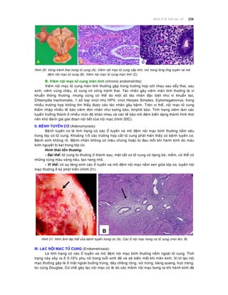 220Beänh lyù heä Sinh duïc nöõ
Hình 20: Voøng traùnh thai trong töû cung (A); Vieâm noäi maïc töû cung caáp tính, muû trong loøng oáng tuyeán vaø moâ
ñeäm noäi maïc töû cung (B). Vieâm noäi maïc töû cung maïn tính (C)
B. Vieâm noäi maïc töû cung maõn tính (chronic endometritis):
Vieâm noäi maïc töû cung maõn tính thöôøng gaëp trong tröôøng hôïp soùt nhau sau saåy thai, sau
sinh, vieâm vuøng chaäu, töû cung coù voøng traùnh thai. Taùc nhaân gaây vieâm maõn tính thöôøng laø vi
khuaån thoâng thöôøng, nhöng cuõng coù theå do moät soá taùc nhaân ñaëc bieät nhö vi khuaån lao,
Chlamydia trachomatis, 1 soá loaïi viruùt nhö HPV, viruùt Herpes Simplex, Cytomegalovirus; trong
nhieàu tröôøng hôïp khoâng tìm thaáy ñöôïc caùc taùc nhaân gaây beänh. Treân vi theå, noäi maïc töû cung
thaám nhaäp nhieàu teá baøo vieâm ñôn nhaân nhö töông baøo, limphoâ baøo. Tình traïng vieâm laøm caùc
tuyeán tröôûng thaønh ôû nhieàu möùc ñoä khaùc nhau vaø caùc teá baøo moâ ñeäm bieán daïng thaønh hình thoi
neân khoù ñaùnh giaù giai ñoaïn noäi tieát cuûa noäi maïc (hình 20C).
II. BEÄNH TUYEÁN CÔ (Adenomyosis):
Beänh tuyeán cô laø tình traïng coù caùc oå tuyeán vaø moâ ñeäm noäi maïc bình thöôøng naèm saâu
trong lôùp cô töû cung. Khoaûng 1/5 caùc tröôøng hôïp caét töû cung phaùt hieän thaáy coù beänh tuyeán cô.
Beänh sinh khoâng roõ. Beänh nhaân khoâng coù trieäu chöùng hoaëc bò ñau moãi khi haønh kinh do maùu
kinh nguyeät bò keït trong lôùp cô.
Hình thaùi toån thöông:
- Ñaïi theå: töû cung to thöôøng ôû thaønh sau, maët caét cô töû cung coù daïng beø, meàm, coù theå coù
nhöõng vuøng maøu vaøng naâu, taïo nang nhoû.
- Vi theå: coù söï taêng sinh caùc oå tuyeán vaø moâ ñeäm noäi maïc naèm xen giöõa lôùp cô, tuyeán noäi
maïc thöôøng ôû kyø phaùt trieån (Hình 21).
Hình 21: Hình aûnh ñaïi theå cuûa beänh tuyeán trong cô (A); Caùc oå noäi maïc trong cô töû cung (muõi teân, B)
III. LAÏC NOÄI MAÏC TÖÛ CUNG (Endometriosis):
Laø tình traïng coù caùc oå tuyeán vaø moâ ñeäm noäi maïc bình thöôøng naèm ngoaøi töû cung. Tình
traïng naøy xaûy ra ôû 5-10% phuï nöõ trong tuoåi sinh ñeû vaø seõ bieán maát khi maõn kinh. Vò trí laïc noäi
maïc thöôøng gaëp laø ôû maët ngoaøi buoàng tröùng, daây chaèng roäng, voøi tröùng, baøng quang, tröïc traøng,
tuùi cuøng Douglas. Cô cheá gaây laïc noäi maïc coù leõ do caùc maûnh noäi maïc bong ra khi haønh kinh ñaõ
 