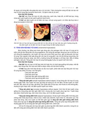 221Beänh lyù heä Sinh duïc nöõ
ñi ngöôïc voøi tröùng ñeán caáy gheùp leân caùc vò trí noùi treân. Trieäâu chöùng laâm saøng noåi baät cuûa laïc noäi
maïc laø tình traïng ñau buïng khi haønh kinh, 1/3 beänh nhaân bò voâ sinh.
Hình thaùi toån thöông:
- Ñaïi theå: caùc oå laïc noäi maïc coù maàu vaøng naâu, xanh naâu, hoaëc ñoû, coù theå hoaù boïc, trong
chöùa dòch xuaát huyeát cuõ (do xuaát huyeát khi haønh kinh).
- Vi theå: caùc ñaùm tuyeán vaø moâ ñeäm noäi maïc, moâ sôïi xung quanh, coù nhieàu ñaïi thöïc baøo öù
ñoïng hemosiderin (Hình 22).
Hình 22: Caùc vò trí laïc noäi maïc töû cung (chaám ñoû, A); Caùc noát laïc noäi maïc maàu naâu xanh ôû buoàng tröùng (B);
Caùc ñaùm tuyeán vaø moâ ñeäm noäi maïc töû cung ôû trong moâ ñeäm buoàng tröùng (C)
iV. TAÊNG SAÛN NOÄI MAÏC TÖÛ CUNG (endometrial hyperplasia):
Bình thöôøng, taùc ñoäng kích thích gaây taêng saûn cuûa estrogen treân noäi maïc töû cung seõ bò
kieàm cheá bôûi taùc ñoäng baûo veä cuûa progesteron. Khi noàng ñoä estrogen taêng quaù cao vaø ñuû laâu so
vôùi noàng ñoä progesteron, caùc tuyeán noäi maïc seõ bò kích thích quaù möùc, gaây ra taêng saûn noäi maïc
töû cung. Caùc nguyeân nhaân gaây taêng saûn noäi maïc töû cung goàm: caùc chu kyø khoâng ruïng tröùng, hoäi
chöùng buoàng tröùng ña nang, caùc khoái u buoàng tröùng tieát estrogen (u teá baøo haït), ñieàu trò baèng
estrogen, beùo phì. Taêng saûn noäi maïc töû cung thöôøng gaëp ôû phuï nöõ quanh tuoåi maõn kinh.
Hình thaùi toån thöông:
- Ñaïi theå: lôùp noäi maïc coù theå daøy toaøn boä hoaëc khu truù döôùi daïng gioáng moät polyp, maät ñoä
meàm, maøu hoàng nhaït. Khi naïo sinh thieát ra ñöôïc nhieàu moâ hôn bình thöôøng.
- Vi theå: döïa treân hình thaùi teá baøo vaø caáu truùc tuyeán, phaân bieät caùc loaïi taêng saûn noäi maïc
töû cung sau (theo Toå chöùc Y teá Theá giôùi):
- Taêng saûn ñôn giaûn
- Taêng saûn phöùc taïp
- Taêng saûn ñôn giaûn khoâng ñieån hình
- Taêng saûn phöùc taïp khoâng ñieån hình
* Taêng saûn ñôn giaûn (simple hyperplasia without atypia): laø loaïi taêng saûn noäi maïc töû cung
thöôøng gaëp nhaát. Caùc tuyeán noäi maïc gia taêng soá löôïng so vôùi moâ ñeäm, teá baøo tuyeán coù nhaân
keùo daøi, ñeàu, leäch veà cöïc ñaùy, giaû taàng. Caùc tuyeán daõn nôû taïo boïc, kích thöôùc to nhoû khoâng ñeàu,
thöôøng coù goùc hoaëc choài, moâ ñeäm quanh tuyeán coøn nhieàu.
* Taêng saûn phöùc taïp (complex hyperplasia without atypia): hình thaùi teá baøo tuyeán cuõng
gioáng nhö trong taêng saûn ñôn giaûn ñieån hình, nhöng caáu truùc tuyeán phöc taïp hôn. Tuyeán taêng
saûn phaân nhaùnh phöùc taïp, naèm chen chuùc nhau, vôùi ít moâ ñeäm quanh tuyeán.
* Taêng saûn khoâng ñieån hình (atypical hyperplasia): teá baøo tuyeán khoâng ñieån hình taêng saûn
choàng chaát nhieàu lôùp teá baøo, nhaân to troøn, nhieãm saéc chaát thoâ, haïch nhaân roõ, maát phaân cöïc, tæ leä
phaân baøo taêng. Caáu truùc tuyeán coù theå ñôn giaûn (goïi laø taêng saûn ñôn giaûn khoâng ñieån hình)
hoaëc phöùc taïp (goïi laø taêng saûn phöùc taïp khoâng ñieån hình). Taêng saûn phöùc taïp khoâng ñieån hình
thöôøng gaëp hôn so vôùi taêng saûn ñôn giaûn khoâng ñieån hình. (Hình 23)
Chæ coù 2% taêng saûn noäi maïc ñôn giaûn vaø phöùc taïp tieán trieån thaønh carcinoâm, trong khi coù
ñeán 23% taêng saûn khoâng ñieån hình tieán trieån thaønh carcinoâm.
 