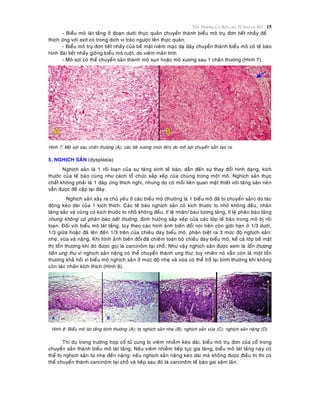 Toån Thöông Cô Baûn cuûa Teá baøo vaø Moâ 15
- Bieåu moâ laùt taàng ôû ñoaïn döôùi thöïc quaûn chuyeån thaønh bieåu moâ truï ñôn tieát nhaày ñeå
thích öùng vôùi axit coù trong dòch vò traøo ngöôïc leân thöïc quaûn.
- Bieåu moâ truï ñôn tieát nhaày cuûa beà maët nieâm maïc daï daøy chuyeån thaønh bieåu moâ coù teà baøo
hình ñaøi tieát nhaày gioáng bieåu moâ ruoät, do vieâm maõn tính
- Moâ sôïi coù theå chuyeån saûn thaønh moâ suïn hoaëc moâ xöông sau 1 chaán thöông (Hình 7).
Hình 7: Moâ sôïi sau chaán thöông (A); caùc beø xöông (muõi teân) do moâ sôïi chuyeån saûn taïo ra.
5. NGHÒCH SAÛN (dysplasia)
Nghòch saûn laø 1 roái loaïn cuûa söï taêng sinh teá baøo, daãn ñeán söï thay ñoåi hình daïng, kích
thöôùc cuûa teá baøo cuõng nhö caùch toå chöùc saép xeáp cuûa chuùng trong moät moâ. Nghòch saûn thöïc
chaát khoâng phaûi laø 1 ñaùp öùng thích nghi, nhöng do coù moái lieân quan maät thieát vôùi taêng saûn neân
vaãn ñöôïc ñeà caäp taïi ñaây.
Nghòch saûn xaûy ra chuû yeáu ôû caùc bieåu moâ (thöôøng laø 1 bieåu moâ ñaõ bò chuyeån saûn) do taùc
ñoäng keùo daøi cuûa 1 kích thích. Caùc teá baøo nghòch saûn coù kích thöôùc to nhoû khoâng ñeàu, nhaân
taêng saéc vaø cuõng coù kích thöôùc to nhoû khoâng ñeàu, tæ leä nhaân/ baøo töông taêng, tæ leä phaân baøo taêng
nhöng khoâng coù phaân baøo baát thöôøng, ñònh höôùng saép xeáp cuûa caùc lôùp teá baøo trong moâ bò roái
loaïn. Ñoái vôùi bieåu moâ laùt taàng, tuøy theo caùc hình aûnh bieán ñoåi noùi treân coøn giôùi haïn ôû 1/3 döôùi,
1/3 giöõa hoaëc ñaõ leân ñeán 1/3 treân cuûa chieàu daøy bieåu moâ, phaân bieät ra 3 möùc ñoä nghòch saûn:
nheï, vöøa vaø naëng. Khi hình aûnh bieán ñoåi ñaõ chieám toaøn boä chieàu daøy bieåu moâ, keå caû lôùp beà maët
thì toån thöông khi ñoù ñöôïc goïi laø carcinoâm taïi choã. Nhö vaäy nghòch saûn ñöôïc xem laø toån thöông
tieàn ung thö vì nghòch saûn naëng coù theå chuyeån thaønh ung thö; tuy nhieân noù vaãn coøn laø moät toån
thöông khaû hoài vì bieåu moâ nghòch saûn ôû möùc ñoä nheï vaø vöøa coù theå trôû laïi bình thöôøng khi khoâng
coøn taùc nhaân kích thích (Hình 8).
Hình 8: Bieåu moâ laùt taàng bình thöôøng (A); bò nghòch saûn nheï (B); nghòch saûn vöøa (C); nghòch saûn naëng (D).
Thí duï trong tröôøng hôïp coå töû cung bò vieâm nhieãm keùo daøi, bieåu moâ truï ñôn cuûa coå trong
chuyeån saûn thaønh bieåu moâ laùt taàng. Neáu vieâm nhieãm tieáp tuïc gia taêng, bieåu moâ laùt taàng naøy coù
theå bò nghòch saûn töø nheï ñeán naëng; neáu nghòch saûn naëng keùo daøi maø khoâng ñöôïc ñieàu trò thì coù
theå chuyeån thaønh carcinoâm taïi choã vaø tieáp sau ñoù laø carcinoâm teá baøo gai xaâm laán.
 