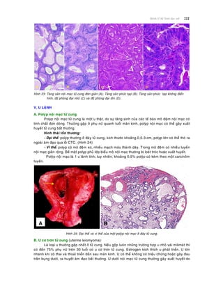 222Beänh lyù heä Sinh duïc nöõ
Hình 23: Taêng saûn noäi maïc töû cung ñôn giaûn (A); Taêng saûn phöùc taïp (B); Taêng saûn phöùc taïp khoâng ñieån
hình, ñoä phoùng ñaïi nhoû (C) vaø ñoä phoùng ñaïi lôùn (D).
V. U LAØNH
A. Polyùp noäi maïc töû cung
Polyp noäi maïc töû cung laø moät u thaät, do söï taêng sinh cuûa caùc teá baøo moâ ñeäm noäi maïc coù
tính chaát ñôn doøng. Thöôøng gaëp ôû phuï nöõ quanh tuoåi maõn kinh, polyùp noäi maïc coù theå gaây xuaát
huyeát töû cung baát thöôøng.
Hình thaùi toån thöông:
- Ñaïi theå: polyp thöôøng ôû ñaùy töû cung, kích thöôùc khoaûng 0,5-3 cm, polyp lôùn coù theå thoø ra
ngoaøi aâm ñaïo qua loã CTC. (Hình 24)
- Vi theå: polyp coù moâ ñeäm xô, nhieàu maïch maùu thaønh daøy. Trong moâ ñeäm coù nhieàu tuyeán
noäi maïc giaõn roäng. Beà maët polyp phuû lôùp bieåu moâ noäi maïc thöôøng bò loeùt troùc hoaëc xuaát huyeát.
Polyùp noäi maïc laø 1 u laønh tính; tuy nhieân, khoaûng 0,5% polyùp coù keøm theo moät carcinoâm
tuyeán.
Hình 24: Ñaïi theå vaø vi theå cuûa moät polyùp noäi maïc ôû ñaùy töû cung.
B. U cô trôn töû cung (uterine leiomyoma):
Laø loaïi u thöôøng gaëp nhaát ôû töû cung. Neáu goäp luoân nhöõng tröôøng hôïp u nhoû vaøi milimeùt thì
coù ñeán 75% phuï nöõ treân 30 tuoåi coù u cô trôn töû cung. Estrogen kích thích u phaùt trieån. U lôùn
nhanh khi coù thai vaø thoaùi trieån daàn sau maõn kinh. U coù theå khoâng coù trieäu chöùng hoaëc gaây ñau
traèn buïng döôùi, ra huyeát aâm ñaïo baát thöôøng. U döôùi noäi maïc töû cung thöôøng gaây xuaát huyeát do
 