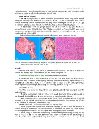 223Beänh lyù heä Sinh duïc nöõ
cheøn eùp noäi maïc. Caùc u lôùn laøm bieán daïng töû cung vaø phaùt hieän ñöôïc khi thaêm khaùm vuøng chaäu.
Nhöõng u coù cuoáng coù theå bò xoaén vaø hoaïi töû do nhoài maùu.
Hình thaùi toån thöông:
- Ñaïi theå: thöôøng coù nhieàu u. U hình troøn, chaéc, giôùi haïn roõ vôùi moâ cô xung quanh. Maët caét
traéng xaùm, coù daïng cuoän. Kích thöôùc töø vaøi mm ñeán 30 cm. U coù theå naèm trong cô, döôùi noäi maïc
vaø döôùi thanh maïc. U döôùi noäi maïc coù theå coù daïng polyùp, thoø ra ngoaøi aâm ñaïo qua loã CTC, goïi
laø u cô trôn xuaát ngoaïi. U coù theå xuaát huyeát khu truù, hoaïi töû, thoaùi hoaù boïc hay hyalin.
- Vi theå: teá baøo u hình thoi gioáng teá baøo cô trôn vôùi nhaân hình baàu duïc coù 2 ñaàu tuø, baøo
töông nhieàu, öa eosin. Tæ leä phaân baøo thaáp. Teá baøo u xeáp thaønh boù. Trong hôn 60% u cô trôn töû
cung coù hieän töôïng thoaùi hoaù hyalin vaø xô hoaù; 10% u cô trôn coù xuaát huyeát khu truù; 4% coù thoaùi
hoaù boïc vaø hoaù voâi (hình 25).
Ñieàu trò baèng phaãu thuaät boùc taùch u hoaëc caét boû toaøn boä töû cung khi u quaù lôùn.
Hình 25: U laønh cô trôn thaân töû cung coù giôùi haïn roõ (A); U daïng polyp thoø ra aâm ñaïo (B); Teá baøo u hình
thoi, nhaân hình baàu duïc, xeáp thaønh boù (C)
VI. U AÙC
Ung thö cuûa thaân töû cung ña soá laø carcinoâm tuyeán noäi maïc; caùc loaïi u aùc khaùc nhö
sarcoâm moâ ñeäm noäi maïc, carcinoâsarcoâm, v.v. chæ chieám khoâng quaù 2 %.
Carcinoâm tuyeán noäi maïc töû cung (endometrial adenocarcinoma):
Carcinoâm noäi maïc töû cung chieám tæ leä 7% ung thö xaâm nhaäp ôû phuï nöõ. Taàn suaát maéc
beänh cao ôû chaâu AÂu vaø Baéc Myõ nhöng thaáp ôû chaâu AÙ, chaâu Phi vaø Nam Myõ. Beänh thöôøng xaûy ra
trong ñoä tuoåi 55-65, ít thaáy ôû phuï nöõ < 40 tuoåi. Ghi nhaän coù söï gia taêng taàn suaát ung thö naøy ôû
nhöõng ngöôøi maéc beänh beùo phì, tieåu ñöôøng, cao huyeát aùp, ñoäc thaân khoâng con.
Cô cheá beänh sinh:
Coù nhieàu baèng chöùng cho thaáy moái lieân quan giöõa taêng saûn noäi maïc töû cung vaø carcinoâm
tuyeán noäi maïc:
- ÔÛ nhöõng ngöôøi beùo phì hoaëc bò roái loaïn kinh nguyeät do chu kyø khoâng ruïng tröùng, coù söï
gia taêng xuaát ñoä cuûa caû 2 beänh lyù, taêng saûn noäi maïc vaø carcinoâm tuyeán noäi maïc.
- Nguy cô carcinoâm tuyeán noäi maïc gia taêng ôû nhöõng tröôøng hôïp u buoàng tröùng coù cheá tieát
estrogen (u teá baøo haït) vaø ôû nhöõng ngöôøi coù duøng lieäu phaùp hormoân estrogen thay theá ñeå ñieàu
trò moät soá beänh, thí duï nhö roái loaïn tieàn maõn kinh.
Do vaäy, phaân bieät 2 nhoùm carcinoâm tuyeán noäi maïc töû cung:
- Nhoùm coù lieân quan vôùi tình traïng kích thích estrogen keùo daøi vaø taêng saûn noäi maïc töû
cung: u thöôøng coù ñoä bieät hoaù cao, dieãn tieán chaäm vaø tieân löôïng toát. Nhoùm naøy chieám 80-85%
caùc tröôøng hôïp carcinoâm tuyeán noäi maïc, beänh nhaân thöôøng treû tuoåi hôn nhoùm sau.
- Nhoùm khoâng coù lieân quan vôùi tình traïng kích thích estrogen vaø khoâng coù taêng saûn noäi
maïc töû cung: u coù ñoä bieät hoaù keùm, tieân löôïng xaáu. Nhoùm naøy chieám 10-15% caùc tröôøng hôïp
carcinoâm tuyeán noäi maïc, beänh nhaân thöôøng lôùn tuoåi, ñaõ maõn kinh vaø coù noäi maïc töû cung teo ñeùt.
 
