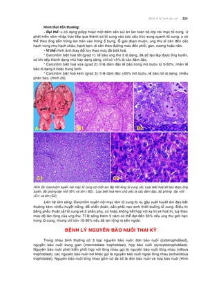 224Beänh lyù heä Sinh duïc nöõ
Hình thaùi toån thöông:
- Ñaïi theå: u coù daïng polyp hoaëc moät ñaùm saàn suøi aên lan toaøn boä lôùp noäi maïc töû cung. U
phaùt trieån xaâm nhaäp tröïc tieáp qua thaønh cô töû cung vaøo caùc caáu truùc xung quanh töû cung; u coù
theå theo oáng daãn tröùng lan traøn vaøo trong oå buïng. ÔÛ giai ñoaïn muoän, ung thö di caên ñeán caùc
haïch vuøng nhö haïch chaäu, haïch beïn; di caên theo ñöôøng maùu ñeán phoåi, gan, xöông hoaëc naõo.
- Vi theå: hình aûnh thay ñoåi tuøy theo möùc ñoä bieät hoaù.
* Carcinoâm bieät hoaù toát (grad 1): teá baøo ung thö ít dò daïng, ña soá taïo laäp ñöôïc oáng tuyeán,
coù khi xeáp thaønh daïng nhuù hay daïng saøng, chæ coù <5% laø caùc ñaùm ñaëc.
* Carcinoâm bieät hoaù vöøa (grad 2): tæ leä ñaùm ñaëc teá baøo trong moâ böôùu töø 5-50%, nhaân teá
baøo dò daïng ít hoaëc trung bình.
* Carcinoâm bieät hoaù keùm (grad 3): tæ leä ñaùm ñaëc >50% moâ böôùu, teá baøo raát dò daïng, nhieàu
phaân baøo. (Hình 26)
Hình 26: Carcinoâm tuyeán noäi maïc töû cung coù choài suøi laáp heát loøng töû cung (A); Loaïi bieät hoaù toát taïo ñöôïc oáng
tuyeán, ñoä phoùng ñaïi nhoû (B1) vaø lôùn ( B2); Loaïi bieät hoaù keùm chuû yeáu laø caùc ñaùm ñaëc, ñoä phoùng ñaïi nhoû
(C1) vaø lôùn (C2).
Lieân heä laâm saøng: Carcinoâm tuyeán noäi maïc laøm töû cung to ra, gaây xuaát huyeát aâm ñaïo baát
thöôøng keøm nhieàu huyeát traéng; ñeå chaån ñoaùn, caàn phaûi naïo sinh thieát buoàng töû cung. Ñieàu trò
baèng phaãu thuaät caét töû cung vaø 2 phaàn phuï, coù hoaëc khoâng keát hôïp vôùi xaï trò vaø hoaù trò, tuyø theo
möùc ñoä lan roäng cuûa ung thö. Tæ leä soáng theâm 5 naêm coù theå ñaït ñeán 95% neáu ung thö giôùi haïn
trong töû cung, nhöng chæ coøn 10-30% neáu ñaõ lan roäng ra beân ngoaøi.
BEÄNH LYÙ NGUYEÂN BAØO NUOÂI THAI KYØ
Trong nhau bình thöôøng coù 3 loaïi nguyeân baøo nuoâi: ñôn baøo nuoâi (cytotrophoblast),
nguyeân baøo nuoâi trung gian (intermediate trophoblast), hôïp baøo nuoâi (syncytiotrophoblast).
Nguyeân baøo nuoâi phaùt trieån phoái hôïp vôùi loâng nhau goïi laø nguyeân baøo nuoâi loâng nhau (villous
trophoblast), caùc nguyeân baøo nuoâi nôi khaùc goïi laø nguyeân baøo nuoâi ngoaøi loâng nhau (extravillous
trophoblast). Nguyeân baøo nuoâi loâng nhau goàm coù ña soá laø ñôn baøo nuoâi vaø hôïp baøo nuoâi (Hình
 