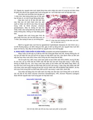 225Beänh lyù heä Sinh duïc nöõ
27). Ngöôïc laïi, nguyeân baøo nuoâi ngoaøi loâng nhau xaâm nhaäp vaøo vaùch töû cung taïi nôi baùm nhau
thì goàm chuû yeáu laø caùc nguyeân baøo nuoâi trung gian vaø 1 soá ít ñôn baøo nuoâi vaø hôïp baøo nuoâi.
Ñôn baøo nuoâi laø teá baøo hình ña giaùc coù
1 nhaân troøn, baøo töông saùng hay coù haït, giôùi
haïn teá baøo roõ, coù moät ít hoaït ñoäng phaân baøo.
Hôïp baøo nuoâi laø teá baøo ñaõ bieät hoùa
cao, tieáp xuùc vôùi tuaàn hoaøn cuûa meï, saûn
xuaát ra nhieàu noäi tieát toá cuûa nhau maø quan
troïng nhaát laø HCG (Human chorionic
gonadotropin). Ñaây laø nhöõng teá baøo lôùn
nhieàu nhaân, baøo töông baét maøu ña saéc vaø coù
nhieàu khoâng baøo, khoâng coù hoaït ñoäng phaân
baøo.
Nguyeân baøo nuoâi trung gian hình ña
giaùc hoaëc hình thoi, lôùn hôn ñôn baøo nuoâi, coù
1 nhaân, baøo töông aùi toan coù vaøi khoâng baøo.
Hình 27: Loâng nhau bình thöôøng vôùi ñôn baøo nuoâi (muõi
teân) vaø hôïp baøo nuoâi (*)
Beänh lyù nguyeân baøo nuoâi thai kyø (gestational trophoblastic diseases) laø moät nhoùm caùc u
vaø toån thöông daïng u coù tieàm naêng aùc tính, gaây ra bôûi söï taêng sinh caùc nguyeân baøo nuoâi lieân
quan vôùi thai kyø. Sau ñaây laø moät soá beänh lyù nguyeân baøo nuoâi thöôøng gaëp:
A. NHAU NÖÔÙC TOAØN PHAÀN VAØ BAÙN PHAÀN (complete and partial hydatidiform mole):
Nhau nöôùc coù theå xaûy ra ôû baát kyø tuoåi naøo trong giai ñoaïn sinh ñeû, nhöng nhöõng phuï nöõ
treû hôn 20 hoaëc lôùn hôn 40 tuoåi thì coù nguy cô maéc beänh cao hôn. Caùc beänh nhaân coù tieàn caên
saåy thai hay nhau nöôùc deã bò nhau nöôùc trong caùc laàn mang thai keá tieáp.
Veà di truyeàn hoïc, 90% nhau nöôùc toaøn phaàn coù boä nhieãm saéc theå laø 46XX, nhöng 2X ñeàu
laø cuûa cha, do söï nhaân ñoâi boä nhieãm saéc theå ñôn boäi cuûa tinh truøng beân trong 1 noaõn roãng,
khoâng coù ADN cuûa meï. 10% nhau nöôùc toaøn phaàn coù boä nhieãm saéc theå 46XX hoaëc 46XY, do
thuï tinh cuûa 2 tinh truøng 23X vaø 23X hoaëc 23X vaø 23Y vaøo trong 1 noaõn roãng. Boä nhieãm saéc theå
cuûa nhau nöôùc baùn phaàn thöôøng laø tam boäi vôùi boä nhieãm saéc theå laø 69XXX hoaëc 69XXY, do thuï
tinh cuûa 2 tinh truøng 23X vaø 23X hoaëc 23X vaø 23Y vaøo trong 1 noaõn 23X. (Hình 28)
Caùc khaûo saùt baèng hoùa moâ mieãn dòch cho thaáy caùc ñôn baøo nuoâi khoâng tieát ra noäi tieát toá;
caùc noäi tieát toá nhö HCG (Human Chorionic Gonadotropin), HPL (Human Placenta Lactogen)
ñöôïc tieát bôûi nguyeân baøo nuoâi trung gian vaø hôïp baøo nuoâi.
Hình 28: Boä nhieãm saéc theå cuûa nhau nöôùc toaøn phaàn vaø baùn phaàn
Noaõn bình thöôøng
 