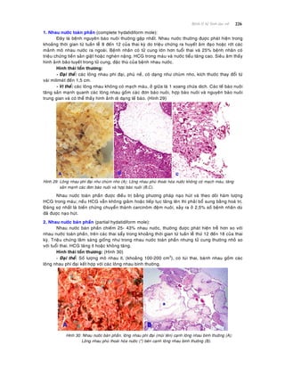 226Beänh lyù heä Sinh duïc nöõ
1. Nhau nöôùc toaøn phaàn (complete hydatidiform mole):
Ñaây laø beänh nguyeân baøo nuoâi thöôøng gaëp nhaát. Nhau nöôùc thöôøng ñöôïc phaùt hieän trong
khoaûng thôøi gian töø tuaàn leã 8 ñeán 12 cuûa thai kyø do trieäu chöùng ra huyeát aâm ñaïo hoaëc rôùt caùc
maûnh moâ nhau nöôùc ra ngoaøi. Beänh nhaân coù töû cung lôùn hôn tuoåi thai vaø 25% beänh nhaân coù
trieäu chöùng tieàn saûn giaät hoaëc ngheùn naëng. HCG trong maùu vaø nöôùc tieåu taêng cao. Sieâu aâm thaáy
hình aûnh baõo tuyeát trong töû cung, ñaëc thuø cuûa beänh nhau nöôùc.
Hình thaùi toån thöông:
- Ñaïi theå: caùc loâng nhau phì ñaïi, phuø neà, coù daïng nhö chuøm nho, kích thöôùc thay ñoåi töø
vaøi milimeùt ñeán 1,5 cm.
- Vi theå: caùc loâng nhau khoâng coù maïch maùu, ôû giöõa laø 1 xoang chöùa dòch. Caùc teá baøo nuoâi
taêng saûn maïnh quanh caùc loâng nhau goàm caùc ñôn baøo nuoâi, hôïp baøo nuoâi vaø nguyeân baøo nuoâi
trung gian vaø coù theå thaáy hình aûnh dò daïng teá baøo. (Hình 29)
Hình 29: Loâng nhau phì ñaïi nhö chuøm nho (A); Loâng nhau phuø thoaùi hoùa nöôùc khoâng coù maïch maùu, taêng
saûn maïnh caùc ñôn baøo nuoâi vaø hôïp baøo nuoâi (B,C).
Nhau nöôùc toaøn phaàn ñöôïc ñieàu trò baèng phöông phaùp naïo huùt vaø theo doõi haøm löôïng
HCG trong maùu; neáu HCG vaãn khoâng giaûm hoaëc tieáp tuïc taêng leân thì phaûi boå sung baèng hoaù trò.
Ñaùng sôï nhaát laø bieán chöùng chuyeån thaønh carcinoâm ñeäm nuoâi, xaûy ra ôû 2,5% soá beänh nhaân duø
ñaõ ñöôïc naïo huùt.
2. Nhau nöôùc baùn phaàn (partial hydatidiform mole):
Nhau nöôùc baùn phaàn chieám 25- 43% nhau nöôùc, thöôøng ñöôïc phaùt hieän treã hôn so vôùi
nhau nöôùc toaøn phaàn, treân caùc thai saåy trong khoaûng thôøi gian töø tuaàn leã thöù 12 ñeán 18 cuûa thai
kyø. Trieäu chöùng laâm saøng gioáng nhö trong nhau nöôùc toaøn phaàn nhöng töû cung thöôøng nhoû so
vôùi tuoåi thai. HCG taêng ít hoaëc khoâng taêng.
Hình thaùi toån thöông: (Hình 30)
- Ñaïi theå: Soá löôïng moâ nhau ít, (khoaûng 100-200 cm3
), coù tuùi thai, baùnh nhau goàm caùc
loâng nhau phì ñaïi keát hôïp vôùi caùc loâng nhau bình thöôøng.
Hình 30: Nhau nöôùc baùn phaàn, loâng nhau phì ñaïi (muõi teân) caïnh loâng nhau bình thöôøng (A);
Loâng nhau phuø thoaùi hoùa nöôùc (*) beân caïnh loâng nhau bình thöôøng (B).
 