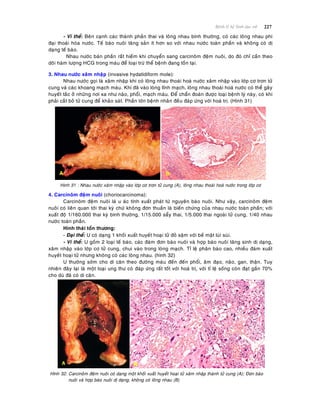 227Beänh lyù heä Sinh duïc nöõ
- Vi theå: Beân caïnh caùc thaønh phaàn thai vaø loâng nhau bình thöôøng, coù caùc loâng nhau phì
ñaïi thoaùi hoùa nöôùc. Teá baøo nuoâi taêng saûn ít hôn so vôùi nhau nöôùc toaøn phaàn vaø khoâng coù dò
daïng teá baøo.
Nhau nöôùc baùn phaàn raát hieám khi chuyeån sang carcinoâm ñeäm nuoâi, do ñoù chæ caàn theo
doõi haøm löôïng HCG trong maùu ñeå loaïi tröø theå beänh ñang toàn taïi.
3. Nhau nöôùc xaâm nhaäp (invasive hydatidiform mole):
Nhau nöôùc goïi laø xaâm nhaäp khi coù loâng nhau thoaùi hoaù nöôùc xaâm nhaäp vaøo lôùp cô trôn töû
cung vaø caùc khoang maïch maùu. Khi ñaõ vaøo loøng tónh maïch, loâng nhau thoaùi hoaù nöôùc coù theå gaây
huyeát taéc ôû nhöõng nôi xa nhö naõo, phoåi, maïch maùu. Ñeå chaån ñoaùn ñöôïc loaïi beänh lyù naøy, coù khi
phaûi caét boû töû cung ñeå khaûo saùt. Phaàn lôùn beänh nhaân ñeàu ñaùp öùng vôùi hoaù trò. (Hình 31)
Hình 31 : Nhau nöôùc xaâm nhaäp vaøo lôùp cô trôn töû cung (A), loâng nhau thoaùi hoaù nöôùc trong lôùp cô
4. Carcinoâm ñeäm nuoâi (choriocarcinoma):
Carcinoâm ñeäm nuoâi laø u aùc tính xuaát phaùt töø nguyeân baøo nuoâi. Nhö vaäy, carcinoâm ñeäm
nuoâi coù lieân quan tôùi thai kyø chöù khoâng ñôn thuaàn laø bieán chöùng cuûa nhau nöôùc toaøn phaàn; vôùi
xuaát ñoä 1/160.000 thai kyø bình thöôøng, 1/15.000 saåy thai, 1/5.000 thai ngoaøi töû cung, 1/40 nhau
nöôùc toaøn phaàn.
Hình thaùi toån thöông:
- Ñaïi theå: U coù daïng 1 khoái xuaát huyeát hoaïi töû ñoû saäm vôùi beà maët luøi suøi.
- Vi theå: U goàm 2 loaïi teá baøo, caùc ñaùm ñôn baøo nuoâi vaø hôïp baøo nuoâi taêng sinh dò daïng,
xaâm nhaäp vaøo lôùp cô töû cung, chui vaøo trong loøng maïch. Tæ leä phaân baøo cao, nhieàu ñaùm xuaát
huyeát hoaïi töû nhöng khoâng coù caùc loâng nhau. (hình 32)
U thöôøng sôùm cho di caên theo ñöôøng maùu ñeán ñeán phoåi, aâm ñaïo, naõo, gan, thaän. Tuy
nhieân ñaây laïi laø moät loaïi ung thö coù ñaùp öùng raát toát vôùi hoaù trò, vôùi tæ leä soáng coøn ñaït gaàn 70%
cho duø ñaõ coù di caên.
Hình 32: Carcinoâm ñeäm nuoâi coù daïng moät khoái xuaát huyeát hoaïi töû xaâm nhaäp thaønh töû cung (A); Ñôn baøo
nuoâi vaø hôïp baøo nuoâi dò daïng, khoâng coù loâng nhau (B)
A
 
