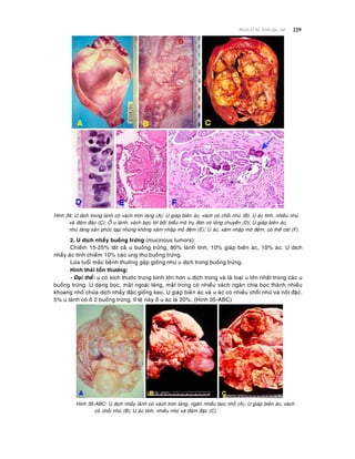 229Beänh lyù heä Sinh duïc nöõ
Hình 34: U dòch trong laønh coù vaùch trôn laùng (A); U giaùp bieân aùc, vaùch coù choài nhuù (B); U aùc tính, nhieàu nhuù
vaø ñaùm ñaëc (C); ÔÛ u laønh, vaùch boïc loùt bôûi bieåu moâ truï ñôn coù loâng chuyeån (D); U giaùp bieân aùc,
nhuù taêng saûn phöùc taïp nhöng khoâng xaâm nhaäp moâ ñeäm (E); U aùc, xaâm nhaäp moâ ñeäm, coù theå caùt (F).
2. U dòch nhaày buoàng tröùng (mucinous tumors):
Chieám 15-25% taát caû u buoàng tröùng, 80% laønh tính, 10% giaùp bieân aùc, 10% aùc. U dòch
nhaày aùc tính chieám 10% caùc ung thö buoàng tröùng.
Löùa tuoåi maéc beänh thöôøng gaëp gioáng nhö u dòch trong buoàng tröùng.
Hình thaùi toån thöông:
- Ñaïi theå: u coù kích thöôùc trung bình lôùn hôn u dòch trong vaø laø loaïi u lôùn nhaát trong caùc u
buoàng tröùng. U daïng boïc, maët ngoaøi laùng, maët trong coù nhieàu vaùch ngaên chia boïc thaønh nhieàu
khoang nhoû chöùa dòch nhaày ñaëc gioáng keo. U giaùp bieân aùc vaø u aùc coù nhieàu choài nhuù vaø noát ñaëc.
5% u laønh coù ôû 2 buoàng tröùng, tæ leä naøy ôû u aùc laø 20%. (Hình 35-ABC)
Hình 35-ABC: U dòch nhaày laønh coù vaùch trôn laùng, ngaên nhieàu boïc nhoû (A); U giaùp bieân aùc, vaùch
coù choài nhuù (B); U aùc tính, nhieàu nhuù vaø ñaùm ñaëc (C).
 