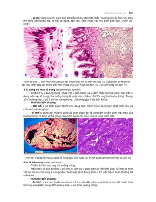 230Beänh lyù heä Sinh duïc nöõ
- Vi theå: trong u laønh, vaùch boïc loùt bieåu moâ truï ñôn tieát nhaày. Tröôøng hôïp aùc tính, lôùp bieåu
moâ taêng saûn nhieàu lôùp, teá baøo dò daïng, taïo nhuù, xaâm nhaäp vaøo moâ ñeäm beân döôùi. (Hình 35-
DEF)
Hình 35-DEF: U dòch nhaày laønh coù vaùch boïc loùt bôûi bieåu moâ truï ñôn tieát nhaày (D); u giaùp bieân aùc taêng saûn
taïo nhuù, nhaân taêng saéc khoâng ñieån hình nhöng chöa xaâm nhaäp moâ ñeäm (E); U aùc xaâm nhaäp moâ ñeäm (F).
3. U daïng noäi maïc töû cung (endometrioid tumour):
Chieám 5% u buoàng tröùng, khaùc vôùi u dòch trong vaø u dòch nhaày buoàng tröùng; haàu heát u
daïng noäi maïc töû cung cuûa buoàng tröùng laø u aùc tính, chieám 15-25% ung thö buoàng tröùng. Trong
30% tröôøng hôïp, u coù ôû caû hai buoàng tröùng. U thöôøng gaëp ôû löùa tuoåi 40-50.
Hình thaùi toån thöông:
- Ñaïi theå: u coù kích thöôùc 10-20 cm, daïng ñaëc, meàm; hoaëc daïng boïc chöùa dòch naâu coù
choài nhoâ vaøo loøng boïc.
-Vi theå: u daïng noäi maïc töû cung aùc (coøn ñöôïc goïi laø carcinoâm tuyeán daïng noäi maïc cuûa
buoàng tröùng) coù hình vi theå gioáng carcinoâm tuyeán noäi maïc cuûa töû cung (hình 36).
Hình 36: U daïng noäi maïc töû cung, coù vuøng ñaëc, vuøng nang (a); Vi theå gioáng carcinoâm noäi maïc töû cung (B)
4. U teá baøo saùng (clear cell tumor):
Chieám 5-10% caùc ung thö buoàng tröùng.
Haàu heát u teá baøo saùng laø u aùc tính. U laønh vaø u giaùp bieân aùc raát hieám gaëp. Raát hay ñi keøm
vôùi laïc noäi maïc töû cung ôû vuøng chaäu. Tuoåi maéc beänh trung bình laø 57 tuoåi, beänh nhaân thöôøng ñaõ
maõn kinh.
Hình thaùi toån thöông:
- Ñaïi theå: u coù kích thöôùc trung bình 15 cm, nöûa ñaëc nöûa nang, thöôøng coù xuaát huyeát hoaïi
töû trong vuøng ñaëc; trong 40% tröôøng hôïp, u coù ôû hai buoàng tröùng.
 