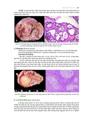 231Beänh lyù heä Sinh duïc nöõ
-Vi theå: trong carcinoâm tuyeán loaïi teá baøo saùng, teá baøo u hình ña dieän, baøo töông nhieàu vaø
saùng, xeáp thaønh caáu truùc oáng, nhuù, hoaëc ñaùm ñaëc naèm treân moâ ñeäm sôïi maïch hoaëc moâ ñeäm
hyaline hoaù. (Hình 37)
Hình 37: U teá baøo saùng aùc tính daïng choài suøi xuaát hieän trong 1 boïc laïc noäi maïc ôû buoàng tröùng (A); teá baøo
u coù baøo töông saùng, xeáp thaønh oáng naèm treân moâ ñeäm hyalin hoaù (B)
5. U Brenner (Brenner tumors):
Chieám 2% u buoàng tröùng. Haàu heát laø u laønh (98%), u giaùp bieân aùc vaø u aùc raát hieám gaëp.
Löùa tuoåi thöôøng gaëp laø 30-60 tuoåi. Trong 8% tröôøng hôïp, u coù ôû caû hai buoàng tröùng
Hình thaùi toån thöông:
- Ñaïi theå: u thöôøng coù kích thöôùc nhoû < 2 cm, chæ coù 10% u lôùn hôn 10 cm. U daïng ñaëc,
giôùi haïn roõ, maät ñoä chaéc, vaøng nhaït, ñoâi khi coù nhöõng boïc nhoû.
- Vi theå: u Brenner caáu taïo bôûi caùc ñaùm teá baøo bieåu moâ gioáng nhö bieåu moâ chuyeån tieáp
cuûa ñöôøng tieát nieäu, nhaân coù raûnh doïc nhö haït caø pheâ, baøo töông nhieàu, treân neàn moâ ñeäm sôïi.
Caùc ñaùm teá baøo u taïo thaønh ñaùm ñaëc, coù caùc loøng nhoû raûi raùc chöùa chaát baét maøu aùi toan. U
Brenner thöôøng phoái hôïp vôùi caùc u khaùc, thöôøng gaëp nhaát laø vôùi u boïc dòch nhaày laønh tính. (Hình
38)
Hình 38: U Brenner coù giôùi haïn roõ, maøu vaøng nhaït (A); Ñaùm teá baøo u gioáng teá baøo chuyeån tieáp, coù hoác nhoû
chöùa dòch.
B. U TEÁ BAØO MAÀM (germ cell tumors):
U teá baøo maàm chieám 15- 20 % caùc u buoàng tröùng; ña soá laø u laønh; u teá baøo maàm aùc chæ
chieám 3% toång soá caùc ung thö buoàng tröùng. U xuaát phaùt töø caùc teá baøo maàm nguyeân thuûy ñaõ bò
chuyeån daïng (trong thôøi kyø phoâi thai, caùc teá baøo naøy di chuyeån töø thaønh beân tuùi noaõn hoaøng ñeán
maøo sinh duïc vaøo tuaàn leã thöù 6). U teá baøo maàm goàm nhieàu loaïi khaùc nhau tuyø theo höôùng vaø
möùc ñoä bieät hoaù cuûa teá baøo maàm nguyeân thuyû: theo höôùng noaõn nguyeân baøo thì coù u nghòch
 