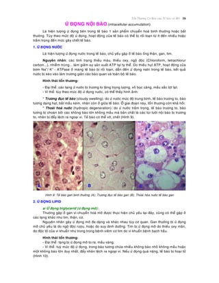 Toån Thöông Cô Baûn cuûa Teá baøo vaø Moâ 16
ÖÙ ÑOÏNG NOÄI BAØO (intracellular accumulation)
Laø hieän töôïng öù ñoïng beân trong teá baøo 1 saûn phaåm chuyeån hoaù bình thöôøng hoaëc baát
thöôøng. Tuøy theo möùc ñoä öù ñoïng, hoaït ñoäng cuûa teá baøo coù theå bò roái loaïn töø ít ñeán nhieàu hoaëc
traàm troïng ñeán möùc gaây cheát teá baøo.
1. ÖÙ ÑOÏNG NÖÔÙC
Laø hieän töôïng öù ñoïng nöôùc trong teá baøo, chuû yeáu gaëp ôû teá baøo oáng thaän, gan, tim.
Nguyeân nhaân: caùc tình traïng thieáu maùu, thieáu oxy, ngoä ñoäc (Chloroform, tetrachlorur
carbon...), nhieãm truøng... laøm giaûm söï saûn xuaát ATP taïi ty theå. Do thieáu huït ATP, hoaït ñoäng cuûa
bôm Na+
/ K+
- ATPase ôû maøng teá baøo bò roái loaïn, daãn ñeán öù ñoïng natri trong teá baøo, keát quaû
nöôùc bò keùo vaøo laøm tröông giaõn caùc baøo quan vaø toaøn boä teá baøo.
Hình thaùi toån thöông:
- Ñaïi theå: caùc taïng öù nöôùc bò tröông to taêng troïng löôïng, voû boïc caêng, maàu saéc lôït laït.
- Vi theå: tuøy theo möùc ñoä öù ñoïng nöôùc, coù theå thaáy hình aûnh:
* Tröông ñuïc teá baøo (cloudy swelling): do öù nöôùc möùc ñoä trung bình, teá baøo tröông to, baøo
töông daïng haït, baét maàu keùm, nhaân coøn ôû giöõa teá baøo. ÔÛ giai ñoaïn naøy, toån thöông coøn khaû hoài.
* Thoaùi hoaù nöôùc (hydropic degeneration): do öù nöôùc traàm troïng, teá baøo tröông to, baøo
töông bò choaùn bôûi caùc khoâng baøo lôùn khoâng maàu maø baûn chaát laø caùc tuùi löôùi noäi baøo bò tröông
to, nhaân bò ñaåy leäch ra ngoaïi vi. Teá baøo coù theå vôõ, cheát (Hình 9).
Hình 9: Teá baøo gan bình thöôøng (A); Tröông ñuïc teá baøo gan (B); Thoaùi hoùa nöôùc teá baøo gan
2. ÖÙ ÑOÏNG LIPID
a/ ÖÙ ñoïng triglycerid (öù ñoïng môõ):
Thöôøng gaëp ôû gan vì chuyeån hoaù môõ ñöôïc thöïc hieän chuû yeáu taïi ñaây, cuõng coù theå gaëp ôû
caùc taïng khaùc nhö tim, thaän, cô.
Nguyeân nhaân gaây öù ñoïng môõ ña daïng vaø khaùc nhau tuøy cô quan. Gan thöôøng bò öù ñoïng
môõ chuû yeáu laø do ngoä ñoäc röôïu, hoaëc do suy dinh döôõng. Tim bò öù ñoïng môõ do thieáu oxy maõn,
do ñoäc toá cuûa vi khuaån nhö trong trong beänh vieâm cô tim do vi khuaån beänh baïch haàu.
Hình thaùi toån thöông:
- Ñaïi theå: taïng bò öù ñoïng môõ to ra, maàu vaøng.
- Vi theå: tuyø möùc ñoä öù ñoïng, trong baøo töông chöùa nhieàu khoâng baøo nhoû khoâng maàu hoaëc
moät khoâng baøo lôùn duy nhaát, ñaåy nhaân leäch ra ngoaïi vi. Neáu öù ñoïng quaù naëng, teá baøo bò hoaïi töû
(Hình 10).
 