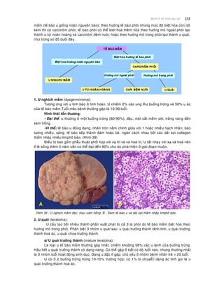 232Beänh lyù heä Sinh duïc nöõ
maàm (teá baøo u gioáng noaõn nguyeân baøo); theo höôùng teá baøo phoâi nhöng möùc ñoä bieät hoùa coøn raát
keùm thì coù carcinoâm phoâi; teáù baøo phoâi coù theå bieät hoaù theâm nöõa theo höôùng moâ ngoaøi phoâi taïo
thaønh u tuùi noaõn hoaøng vaø carcinoâm ñeäm nuoâi, hoaëc theo höôùng moâ trong phoâi taïo thaønh u quaùi,
nhö trong sô ñoà döôùi ñaây.
1. U nghòch maàm (dysgerminoma):
Töông öùng vôùi u tinh baøo ôû tinh hoaøn. U chieám 2% caùc ung thö buoàng tröùng vaø 50% u aùc
cuûa teá baøo maàm.Tuoåi maéc beänh thöôøng gaëp laø 10-30 tuoåi.
Hình thaùi toån thöông:
- Ñaïi theå: u thöôøng ôû moät buoàng tröùng (80-90%), ñaëc, maët caét meàm öôùt, traéng vaøng ñeán
xaùm hoàng.
-Vi theå: teá baøo u ñoàng daïng, nhaân troøn naèm chính giöõa vôùi 1 hoaëc nhieàu haïch nhaân; baøo
töông nhieàu, saùng; teá baøo xeáp thaønh ñaùm hoaëc beø, ngaên caùch nhau bôûi caùc daûi sôïi collagen
thaám nhaäp nhieàu limphoâ baøo. (Hình 39)
Ñieàu trò bao goàm phaãu thuaät phoái hôïp vôùi xaï trò vaø vaø hoaù trò. U raát nhaïy vôùi xaï vaø hoaù neân
tæ leä soáng theâm 5 naêm vaãn coù theå ñaït ñeán 80% cho duø phaùt hieän ôû giai ñoaïn muoän.
Hình 39 : U nghòch maàm ñaëc, maøu xaùm hoàng. B : Ñaùm teá baøo u vaø daûi sôïi thaám nhaäp limphoâ baøo.
2. U quaùi (teratoma):
U caáu taïo bôûi nhieàu thaønh phaàn xuaát phaùt töø caû 3 laù phoâi do teá baøo maàm bieät hoaù theo
höôùng moâ trong phoâi. Phaân bieät 3 nhoùm u quaùi sau: u quaùi tröôûng thaønh laønh tính, u quaùi tröôûng
thaønh hoaù aùc, u quaùi chöa tröôûng thaønh.
a/ U quaùi tröôûng thaønh (mature teratoma):
Laø loaïi u teá baøo maàm thöôøng gaëp nhaát, chieám khoaûng 58% caùc u laønh cuûa buoàng tröùng.
Haàu heát u quaùi tröôûng thaønh coù daïng nang. Coù theå gaëp ôû baát cöù ñoä tuoåi naøo, nhöng thöôøng nhaát
laø ôû nhoùm tuoåi hoaït ñoäng sinh duïc. Daïng u ñaëc ít gaëp, chuû yeáu ôû nhoùm beänh nhaân treû < 20 tuoåi.
U coù ôû 2 buoàng tröùng trong 10-15% tröôøng hôïp; coù 1% bò chuyeån daïng aùc tính goïi laø u
quaùi tröôûng thaønh hoaù aùc.
 