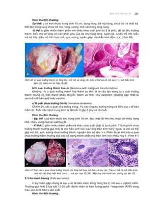 233Beänh lyù heä Sinh duïc nöõ
Hình thaùi toån thöông:
Ñaïi theå: u coù kích thöôùc trung bình 15 cm, daïng nang, beà maët laùng, chöùa toùc vaø chaát baõ.
Noát ñaëc trong nang chöùa moâ môõ, raêng, xöông, nhoâ vaøo trong loøng nang.
Vi theå: u goàm nhieàu thaønh phaàn moâ khaùc nhau xuaát phaùt töø 3 laù phoâi, taát caû ñeàu tröôûng
thaønh: bieåu moâ laùt taàng vôùi caùc phaàn phuï cuûa da nhö nang loâng, tuyeán baõ, tuyeán moà hoâi, bieåu
moâ hoâ haáp, bieåu moâ tieâu hoaù, môõ, suïn, xöông, tuyeán giaùp, moâ thaàn kinh ñeäm, v.v. (Hình 40)
Hình 40: U quaùi tröôûng thaønh coù loâng toùc, moâ môõ vaø raêng (A); treân vi theå coù coù moâ suïn (1), moâ thaàn kinh
ñeäm (2), bieåu moâ hoâ haáp (3) (B)
b/ U quaùi tröôûng thaønh hoaù aùc (teratoma with malignant transformation):
Khoaûng 1% u quaùi tröôûng thaønh hoaù thaønh aùc tính. U coù caáu taïo töông töï u quaùi tröôûng
thaønh nhöng coù moät thaønh phaàn chuyeån thaønh aùc tính, nhö carcinoâm (thöôøng gaëp nhaát laø
carcinoâm teá baøo gai) hoaëc sarcoâm.
c/ U quaùi chöa tröôûng thaønh (immature teratoma):
Chieám 3% caùc u quaùi cuûa buoàng tröùng, 1% caùc ung thö buoàng tröùng vaø 20% caùc u teá baøo
maàm aùc. Tuoåi maéc beänh trung bình laø 18 tuoåi, Ít gaëp ôû phuï nöõ lôùn tuoåi.
Hình thaùi toån thöông:
- Ñaïi theå: u coù kích thöôùc lôùn, trung bình 18 cm, ñaëc, maët caét nhö thòt, hoaëc coù nhieàu nang
nhoû, nhieàu vuøng hoaïi töû xuaát huyeát.
- Vi theå: U goàm nhieàu thaønh phaàn moâ khaùc nhau xuaát phaùt töø ba laù phoâi. Thaønh phaàn chöa
tröôûng thaønh thöôøng gaëp nhaát laø moâ thaàn kinh non (caùc oáng thaàn kinh non); ngoaøi ra coøn coù theå
gaëp moâ môõ, suïn, xöông chöa tröôûng thaønh, nguyeân baøo cô vaân, v.v. Phaân ñoä aùc tính cuûa u quaùi
chöa tröôûng thaønh thöôøng döïa vaøo soá löôïng thaønh phaàn moâ thaàn kinh non nhieàu hay ít. (Hình 41)
Hình 41: Maët caét u quaùi chöa tröôûng thaønh cho thaáy keát hôïp moâ ñaëc vaø boïc (A); Treân vi theå coù moâ thaàn kinh
non vôùi caùc oáng thaàn kinh non (1), moâ suïn non (2) (B); Moät oáng thaàn kinh non phoùng ñaïi lôùn (C)
3. U tuùi noaõn hoaøng (Yolk sac tumor):
U tuy hieám gaëp nhöng laø loaïi u aùc teá baøo maàm ñöùng haøng thöù 2, chæ sau u nghòch maàm.
Thöôøng gaëp nhaát ôû löùa tuoåi 10-20 tuoåi. Beänh nhaân coù haøm löôïng alpha - fetoprotein (AFP) trong
maùu cao do teá baøo u saûn xuaát.
Hình thaùi toån thöông:
 