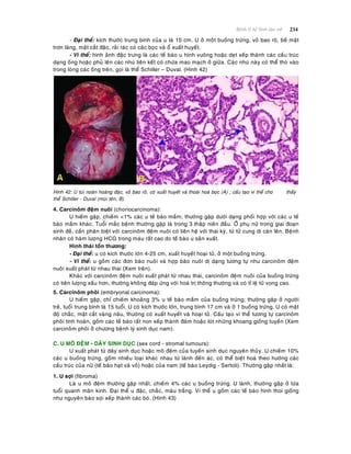 234Beänh lyù heä Sinh duïc nöõ
- Ñaïi theå: kích thöôùc trung bình cuûa u laø 15 cm. U ôû moät buoàng tröùng, voû bao roõ, beà maët
trôn laùng, maët caét ñaëc, raûi raùc coù caùc boïc vaø oå xuaát huyeát.
- Vi theå: hình aûnh ñaëc tröng laø caùc teá baøo u hình vuoâng hoaëc deït xeáp thaønh caùc caáu truùc
daïng oáng hoaëc phuû leân caùc nhuù lieân keát coù chöùa mao maïch ôû giöõa. Caùc nhuù naøy coù theå thoø vaøo
trong loøng caùc oáng treân, goïi laø theå Schiller – Duval. (Hình 42)
Hình 42: U tuùi noaõn hoaøng ñaëc, voû bao roõ, coù xuaát huyeát vaø thoaùi hoaù boïc (A) ; caáu taïo vi theå cho thaáyù
theå Schiller - Duval (muõi teân, B).
4. Carcinoâm ñeäm nuoâi (choriocarcinoma):
U hieám gaëp, chieám <1% caùc u teá baøo maàm; thöôøng gaëp döôùi daïng phoái hôïp vôùi caùc u teá
baøo maàm khaùc. Tuoåi maéc beänh thöôøng gaëp laø trong 3 thaäp nieân ñaàu. ÔÛ phuï nöõ trong giai ñoaïn
sinh ñeû, caàn phaân bieät vôùi carcinoâm ñeäm nuoâi coù lieân heä vôùi thai kyø, töø töû cung di caên leân. Beänh
nhaân coù haøm löôïng HCG trong maùu raát cao do teá baøo u saûn xuaát.
Hình thaùi toån thöông:
- Ñaïi theå: u coù kích thöôùc lôùn 4-25 cm, xuaát huyeát hoaïi töû, ôû moät buoàng tröùng.
- Vi theå: u goàm caùc ñôn baøo nuoâi vaø hôïp baøo nuoâi dò daïng töông töï nhö carcinoâm ñeäm
nuoâi xuaát phaùt töø nhau thai (Xem treân).
Khaùc vôùi carcinoâm ñeäm nuoâi xuaát phaùt töø nhau thai, carcinoâm ñeäm nuoâi cuûa buoàng tröùng
coù tieân löôïng xaáu hôn, thöôøng khoâng ñaùp öùng vôùi hoaù trò thoâng thöôøng vaø coù tæ leä töû vong cao.
5. Carcinoâm phoâi (embryonal carcinoma):
U hieám gaëp, chæ chieám khoaûng 3% u teá baøo maàm cuûa buoàng tröùng; thöôøng gaëp ôû ngöôøi
treû, tuoåi trung bình laø 15 tuoåi. U coù kích thöôùc lôùn, trung bình 17 cm vaø ôû 1 buoàng tröùng. U coù maät
ñoä chaéc, maët caét vaøng naâu, thöôøng coù xuaát huyeát vaø hoaïi töû. Caáu taïo vi theå töông töï carcinoâm
phoâi tinh hoaøn, goàm caùc teá baøo raát non xeáp thaønh ñaùm hoaëc loùt nhöõng khoang gioáng tuyeán (Xem
carcinoâm phoâi ôû chöông beänh lyù sinh duïc nam).
C. U MOÂ ÑEÄM - DAÂY SINH DUÏC (sex cord - stromal tumours):
U xuaát phaùt töø daây sinh duïc hoaëc moâ ñeäm cuûa tuyeán sinh duïc nguyeân thuûy. U chieám 10%
caùc u buoàng tröùng, goàm nhieàu loaïi khaùc nhau töø laønh ñeán aùc, coù theå bieät hoaù theo höôùng caùc
caáu truùc cuûa nöõ (teá baøo haït vaø voû) hoaëc cuûa nam (teá baøo Leydig - Sertoli). Thöôøng gaëp nhaát laø:
1. U sôïi (fibroma)
Laø u moâ ñeäm thöôøng gaëp nhaát, chieám 4% caùc u buoàng tröùng. U laønh, thöôøng gaëp ôû löùa
tuoåi quanh maõn kinh. Ñaïi theå u ñaëc, chaéc, maøu traéng. Vi theå u goàm caùc teá baøo hình thoi gioáng
nhö nguyeân baøo sôïi xeáp thaønh caùc boù. (Hình 43)
 