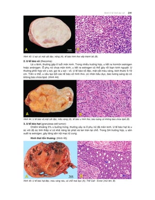 235Beänh lyù heä Sinh duïc nöõ
Hình 43: U sôïi coù maët caét ñaëc, traéng (A), teá baøo hình thoi xeáp thaønh boù (B).
2. U teá baøo voû (thecoma):
Laø u laønh, thöôøng gaëp ôû tuoåi maõn kinh. Trong nhieàu tröôøng hôïp, u tieát ra hormoân estrogen
hoaëc androgen. ÔÛ phuï nöõ chöa maõn kinh, u tieát ra estrogen coù theå gaây roái loaïn kinh nguyeät. U
thöôøng phoái hôïp vôùi u sôïi, goïi laø u sôïi - voû. U teá baøo voû ñaëc, maët caét maøu vaøng, kích thöôùc 5-10
cm. Treân vi theå, u caáu taïo bôûi caùc teá baøo voû hình thoi, coù nhaân baàu duïc, baøo töông saùng do coù
khoâng baøo chöùa lipid. (Hình 44)
Hình 44: U teá baøo voû,maët caét ñaëc, maàu vaøng (A); teá baøo u hình thoi, baøo töông coù khoâng baøo chöùa lipid (B)
3. U teá baøo haït (granulosa cell tumor):
Chieám khoaûng 5% u buoàng tröùng, thöôøng xaûy ra ôû phuï nöõ ñaõ maõn kinh. U teá baøo haït laø u
aùc vôùi ñoä aùc tính thaáp vì coù khaû naêng taùi phaùt vaø lan traøn taïi choã. Trong 3/4 tröôøng hôïp, u saûn
xuaát ra estrogen, gaây taêng saûn noäi maïc töû cung.
Hình thaùi toån thöông: (Hình 45)
Hình 45: U teá baøo haït ñaëc, maøu vaøng naâu, coù choã hoaù boïc (A); Theå Call - Exner (muõi teân, B).
 