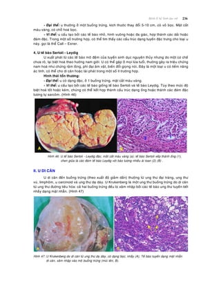 236Beänh lyù heä Sinh duïc nöõ
- Ñaïi theå: u thöôøng ôû moät buoàng tröùng, kích thöôùc thay ñoåi 5-10 cm, coù voû boïc. Maët caét
maøu vaøng, coù choã hoaù boïc.
- Vi theå: u caáu taïo bôûi caùc teá baøo nhoû, hình vuoâng hoaëc ña giaùc, hôïp thaønh caùc daûi hoaëc
ñaùm ñaëc. Trong moät soá tröôøng hôïp, coù theå tìm thaáy caùc caáu truùc daïng tuyeán ñaëc tröng cho loaïi u
naøy, goïi laø theå Call – Exner.
4. U teá baøo Sertoli - Leydig
U xuaát phaùt töø caùc teá baøo moâ ñeäm cuûa tuyeán sinh duïc nguyeân thuûy nhöng do moät cô cheá
chöa roõ, laïi bieät hoaù theo höôùng nam giôùi. U coù theå gaëp ôû moïi löùa tuoåi, thöôøng gaây ra trieäu chöùng
nam hoaù nhö chöùng raäm loâng, phì ñaïi aâm vaät, bieán ñoåi gioïng noùi. Ñaây laø moät loaïi u coù tieàm naêng
aùc tính, coù theå cho di caên hoaëc taùi phaùt trong moät soá ít tröôøng hôïp.
Hình thaùi toån thöông:
- Ñaïi theå: u coù daïng ñaëc, ôû 1 buoàng tröùng, maët caét maøu vaøng.
- Vi theå: u caáu taïo bôûi caùc teá baøo gioáng teá baøo Sertoli vaø teá baøo Leydig. Tuøy theo möùc ñoä
bieät hoaù toát hoaëc keùm, chuùng coù theå keát hôïp thaønh caáu truùc daïng oáng hoaëc thaønh caùc ñaùm ñaëc
töông töï sarcoâm. (Hình 46)
Hình 46: U teá baøo Sertoli - Leydig ñaëc, maét caét maøu vaøng (a); teá baøo Sertoli xeáp thaønh oáng (1),
chen giöõa laø caùc ñaùm teá baøo Leydig vôùi baøo töông nhieàu aùi toan (2) (B) .
II. U DI CAÊN
U di caên ñeán buoàng tröùng (theo xuaát ñoä giaûm daàn) thöôøng töø ung thö ñaïi traøng, ung thö
vuù, limphoâm, u carcinoid vaø ung thö daï daøy. U Krukenberg laø moät ung thö buoàng tröùng do di caên
töø ung thö ñöôøng tieâu hoùa: caû hai buoàng tröùng ñeàu bò xaâm nhaäp bôûi caùc teá baøo ung thö tuyeán tieát
nhaày daïng maët nhaãn. (Hình 47)
Hình 47: U Krukenberg do di caên töø ung thö daï daøy, coù daïng boïc, nhaày (A); Teá baøo tuyeán daïng maët nhaãn
di caên, xaâm nhaäp vaøo moâ buoàng tröùng (muõi teân, B).
 