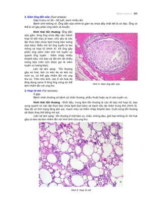 Beänh lyù tuyeán vuù 241
2. Giaõn oáng daãn söõa (Duct ectasia):
Gaëp ôû phuï nöõ 50 – 60 tuoåi, sanh nhieàu laàn
Beänh sinh khoâng roõ. OÁng daãn söõa chính bò giaõn do chöùa ñaày chaát tieát bò coâ ñaëc. OÁng coù
theå bò vôõ gaây phaûn öùng vieâm voâ khuaån.
Hình thaùi toån thöông: OÁng daãn
söõa giaõn, loøng oáng chöùa ñaày caùc maûnh
hoaïi töû baét maøu aùi toan, chuû yeáu laø caùc
ñaïi thöïc baøo chöùa lipid trong baøo töông
(boït baøo). Bieåu moâ loùt oáng tuyeán bò teo
moûng vaø hoaïi töû (Hình 4). Vôõ oáng gaây
phaûn öùng vieâm maõn tính moâ tuyeán vuù
quanh oáng tuyeán : thaám nhaäp nhieàu
limphoâ baøo, moâ baøo vaø ñoâi khi raát nhieàu
töông baøo (neân coøn ñöôïc goïi laø vieâm
tuyeán vuù töông baøo).
Lieân heä laâm saøng: Toån thöông
gaây xô hoaù, laøm co keùo da vaø keùo tuït
nuùm vuù, coù theå gaây nhaàm laãn vôùi ung
thö vuù. Treân nhuõ aûnh, caùc oå voâi hoaù do
laéng ñoïng canxi ôû loøng oáng cuõng coù theå
laøm nhaàm laãn vôùi ung thö.
Hình 4: Giaõn oáng daãn söõa.
3. Hoaïi töû môõ (Fat necrosis):
Ít gaëp.
Beänh nhaân thöôøng coù beänh söû chaán thöông, phaãu thuaät hoaëc xaï trò vaøo tuyeán vuù.
Hình thaùi toån thöông : Khôûi ñaàu, trung taâm toån thöông laø caùc teá baøo môõ hoaïi töû, bao
xung quanh coù caùc ñaïi thöïc baøo chöùa lipid (boït baøo) vaø baïch caàu ña nhaân trung tính (Hình 5).
Sau ñoù coù tình traïng taêng saûn sôïi, maïch maùu vaø thaám nhaäp limphoâ baøo. Cuoái cuøng toån thöông
seõ ñöôïc thay theá baèng moâ sôïi.
Lieân heä laâm saøng : toån thöông ôû moät beân vuù, chaéc, khoâng ñau, giôùi haïn khoâng roõ. Xô hoaù
gaây co keùo da laøm nhaàm laãn vôùi hình aûnh cuûa ung thö.
Hình 5: Hoaïi töû môõ
 