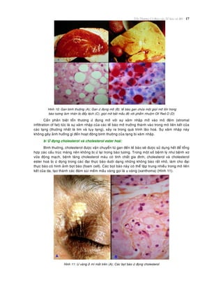 Toån Thöông Cô Baûn cuûa Teá baøo vaø Moâ 17
Hình 10: Gan bình thöôøng (A); Gan öù ñoïng môõ (B); teá baøo gan chöùa moät gioït môõ lôùn trong
baøo töông laøm nhaân bò ñaåy leäch (C); gioït môõ baét maàu ñoû vôùi phaåm nhuoäm Oil Red O (D)
Caàn phaân bieät toån thöông öù ñoïng môõ vôùi söï xaâm nhaäp môõ vaøo moâ ñeäm (stromal
infiltration of fat) töùc laø söï xaâm nhaäp cuûa caùc teá baøo môõ tröôûng thaønh vaøo trong moâ lieân keát cuûa
caùc taïng (thöôøng nhaát laø tim vaø tuïy taïng), xaûy ra trong quaù trình laõo hoaù. Söï xaâm nhaäp naøy
khoâng gaây aûnh höôûng gì ñeán hoaït ñoäng bình thöôøng cuûa taïng bò xaâm nhaäp.
b/ ÖÙ ñoïng cholesterol vaø cholesterol ester hoaù:
Bình thöôøng, cholesterol ñöôïc vaän chuyeån töø gan ñeán teá baøo seõ ñöôïc söû duïng heát ñeå toång
hôïp caùc caáu truùc maøng neân khoâng bò öù laïi trong baøo töông. Trong moät soá beänh lyù nhö beänh xô
vöõa ñoäng maïch, beänh taêng cholesterol maùu coù tính chaát gia ñình; cholesterol vaø cholesterol
ester hoaù bò öù ñoïng trong caùc ñaïi thöïc baøo döôùi daïng nhöõng khoâng baøo raát nhoû, laøm cho ñaïi
thöïc baøo coù hình aûnh boït baøo (foam cell). Caùc boït baøo naøy coù theå taäp trung nhieàu trong moâ lieân
keát cuûa da, taïo thaønh caùc ñaùm suøi meàm maàu vaøng goïi laø u vaøng (xanthoma) (Hình 11).
Hình 11: U vaøng ôû mí maét treân (A); Caùc boït baøo öù ñoïng cholesterol
 