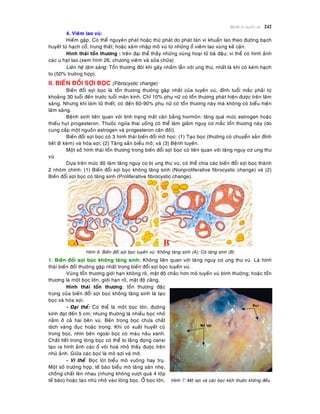 Beänh lyù tuyeán vuù 242
4. Vieâm lao vuù:
Hieám gaëp. Coù theå nguyeân phaùt hoaëc thöù phaùt do phaùt taùn vi khuaån lao theo ñöôøng baïch
huyeát töø haïch coå, trung thaát; hoaëc xaâm nhaäp moâ vuù töø nhöõng oå vieâm lao vuøng keá caän.
Hình thaùi toån thöông : treân ñaïi theå thaáy nhöõng vuøng hoaïi töû baõ ñaäu; vi theå coù hình aûnh
caùc u haït lao.(xem hình 26, chöông vieâm vaø söûa chöõa)
Lieân heä laâm saøng: Toån thöông ñoâi khi gaây nhaàm laãn vôùi ung thö, nhaát laø khi coù keøm haïch
to (50% tröôøng hôïp).
II. BIEÁN ÑOÅI SÔÏI BOÏC (Fibrocystic change):
Bieán ñoåi sôïi boïc laø toån thöông thöôøng gaëp nhaát cuûa tuyeán vuù, ñænh tuoåi maéc phaûi töø
khoaûng 30 tuoåi ñeán tröôùc tuoåi maõn kinh. Chæ 10% phuï nöõ coù toån thöông phaùt hieän ñöôïc treân laâm
saøng. Nhöng khi laøm töû thieát, coù ñeán 60-90% phuï nöõ coù toån thöông naøy maø khoâng coù bieåu hieän
laâm saøng.
Beänh sinh lieân quan vôùi tình traïng maát caân baèng hormoân: taêng quaù möùc estrogen hoaëc
thieáu huït progesteron. Thuoác ngöøa thai uoáng coù theå laøm giaûm nguy cô maéc toån thöông naøy (do
cung caáp moät nguoàn estrogen vaø progesteron caân ñoái).
Bieán ñoåi sôïi boïc coù 3 hình thaùi bieán ñoåi moâ hoïc: (1) Taïo boïc (thöôøng coù chuyeån saûn ñænh
tieát ñi keøm) vaø hoùa sôïi; (2) Taêng saûn bieåu moâ; vaø (3) Beänh tuyeán.
Moät soá hình thaùi toån thöông trong bieán ñoåi sôïi boïc coù lieân quan vôùi taêng nguy cô ung thö
vuù
Döïa treân möùc ñoä laøm taêng nguy cô bò ung thö vuù, coù theå chia caùc bieán ñoåi sôïi boïc thaønh
2 nhoùm chính: (1) Bieán ñoåi sôïi boïc khoâng taêng sinh (Nonproliferative fibrocystic change) vaø (2)
Bieán ñoåi sôïi boïc coù taêng sinh (Proliferative fibrocystic change).
Hình 6: Bieán ñoåi sôïi boïc tuyeán vuù: Khoâng taêng sinh (A); Coù taêng sinh (B)
1. Bieán ñoåi sôïi boïc khoâng taêng sinh: Khoâng lieân quan vôùi taêng nguy cô ung thö vuù. Laø hình
thaùi bieán ñoåi thöôøng gaëp nhaát trong bieán ñoåi sôïi boïc tuyeán vuù.
Vuøng toån thöông giôùi haïn khoâng roõ, maät ñoä chaéc hôn moâ tuyeán vuù bình thöôøng; hoaëc toån
thöông laø moät boïc lôùn, giôùi haïn roõ, maät ñoä caêng.
Hình thaùi toån thöông: toån thöông ñaëc
tröng cuûa bieán ñoåi sôïi boïc khoâng taêng sinh laø taïo
boïc vaø hoùa sôïi.
- Ñaïi theå: Coù theå laø moät boïc lôùn, ñöôøng
kính ñaït ñeán 5 cm; nhöng thöôøng laø nhieàu boïc nhoû
naèm ôû caû hai beân vuù. Beân trong boïc chöùa chaát
dòch vaøng ñuïc hoaëc trong. Khi coù xuaát huyeát cuõ
trong boïc, nhìn beân ngoaøi boïc coù maøu naâu xanh.
Chaát tieát trong loøng boïc coù theå bò laéng ñoïng canxi
taïo ra hình aûnh caùc oå voâi hoaù nhoû thaáy ñöôïc treân
nhuõ aûnh. Giöõa caùc boïc laø moâ sôïi vaø môõ.
- Vi theå: Boïc loùt bieåu moâ vuoâng hay truï.
Moät soá tröôøng hôïp, teá baøo bieåu moâ taêng saûn nheï,
choàng chaát leân nhau (nhöng khoâng vöôït quaù 4 lôùp
teá baøo) hoaëc taïo nhuù nhoâ vaøo loøng boïc. ÔÛ boïc lôùn, Hình 7: Moâ sôïi vaø caùc boïc kích thöôùc khoâng ñeàu.
 