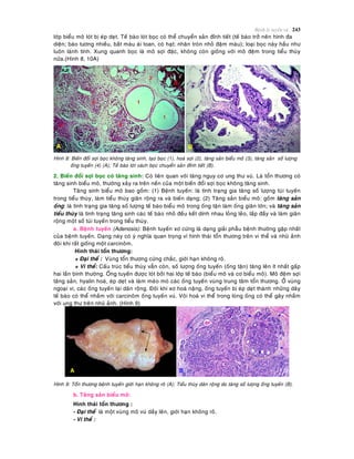 Beänh lyù tuyeán vuù 243
lôùp bieåu moâ loùt bò eùp deït. Teá baøo loùt boïc coù theå chuyeån saûn ñænh tieát (teá baøo trôû neân hình ña
dieän; baøo töông nhieàu, baét maøu aùi toan, coù haït; nhaân troøn nhoû ñaäm maøu); loaïi boïc naøy haàu nhö
luoân laønh tính. Xung quanh boïc laø moâ sôïi ñaëc, khoâng coøn gioáng vôùi moâ ñeäm trong tieåu thuøy
nöõa.(Hình 8, 10A)
Hình 8: Bieán ñoåi sôïi boïc khoâng taêng sinh, taïo boïc (1), hoaù sôïi (2), taêng saûn bieåu moâ (3), taêng saûn soá löôïng
oáng tuyeán (4) (A); Teá baøo loùt vaùch boïc chuyeån saûn ñænh tieát (B).
2. Bieán ñoåi sôïi boïc coù taêng sinh: Coù lieân quan vôùi taêng nguy cô ung thö vuù. Laø toån thöông coù
taêng sinh bieåu moâ, thöôøng xaûy ra treân neàn cuûa moät bieán ñoåi sôïi boïc khoâng taêng sinh.
Taêng sinh bieåu moâ bao goàm: (1) Beänh tuyeán: laø tình traïng gia taêng soá löôïng tuùi tuyeán
trong tieåu thuøy, laøm tieåu thuøy giaõn roäng ra vaø bieán daïng; (2) Taêng saûn bieåu moâ: goàm taêng saûn
oáng: laø tình traïng gia taêng soá löôïng teá baøo bieåu moâ trong oáng taän laøm oáng giaõn lôùn; vaø taêng saûn
tieåu thuøy laø tình traïng taêng sinh caùc teá baøo nhoû ñeàu keát dính nhau loûng leûo, laáp ñaày vaø laøm giaõn
roäng moät soá tuùi tuyeán trong tieåu thuøy.
a. Beänh tuyeán (Adenosis): Beänh tuyeán xô cöùng laø daïng giaûi phaãu beänh thöôøng gaëp nhaát
cuûa beänh tuyeán. Daïng naøy coù yù nghóa quan troïng vì hình thaùi toån thöông treân vi theå vaø nhuõ aûnh
ñoâi khi raát gioáng moät carcinoâm.
Hình thaùi toån thöông:
+ Ñaïi theå : Vuøng toån thöông cöùng chaéc, giôùi haïn khoâng roõ.
+ Vi theå: Caáu truùc tieåu thuøy vaãn coøn, soá löôïng oáng tuyeán (oáng taän) taêng leân ít nhaát gaáp
hai laàn bình thöôøng. OÁng tuyeán ñöôïc loùt bôûi hai lôùp teá baøo (bieåu moâ vaø cô bieåu moâ). Moâ ñeäm sôïi
taêng saûn, hyalin hoaù, eùp deït vaø laøm meùo moù caùc oáng tuyeán vuøng trung taâm toån thöông. ÔÛ vuøng
ngoaïi vi, caùc oáng tuyeán laïi daõn roäng. Ñoâi khi xô hoaù naëng, oáng tuyeán bò eùp deït thaønh nhöõng daây
teá baøo coù theå nhaàm vôùi carcinoâm oáng tuyeán vuù. Voâi hoaù vi theå trong loøng oáng coù theå gaây nhaàm
vôùi ung thö treân nhuõ aûnh. (Hình 9)
Hình 9: Toån thöông beänh tuyeán giôùi haïn khoâng roõ (A); Tieåu thuøy daõn roäng do taêng soá löôïng oáng tuyeán (B).
b. Taêng saûn bieåu moâ:
Hình thaùi toån thöông :
- Ñaïi theå laø moät vuøng moâ vuù daày leân, giôùi haïn khoâng roõ.
- Vi theå :
 